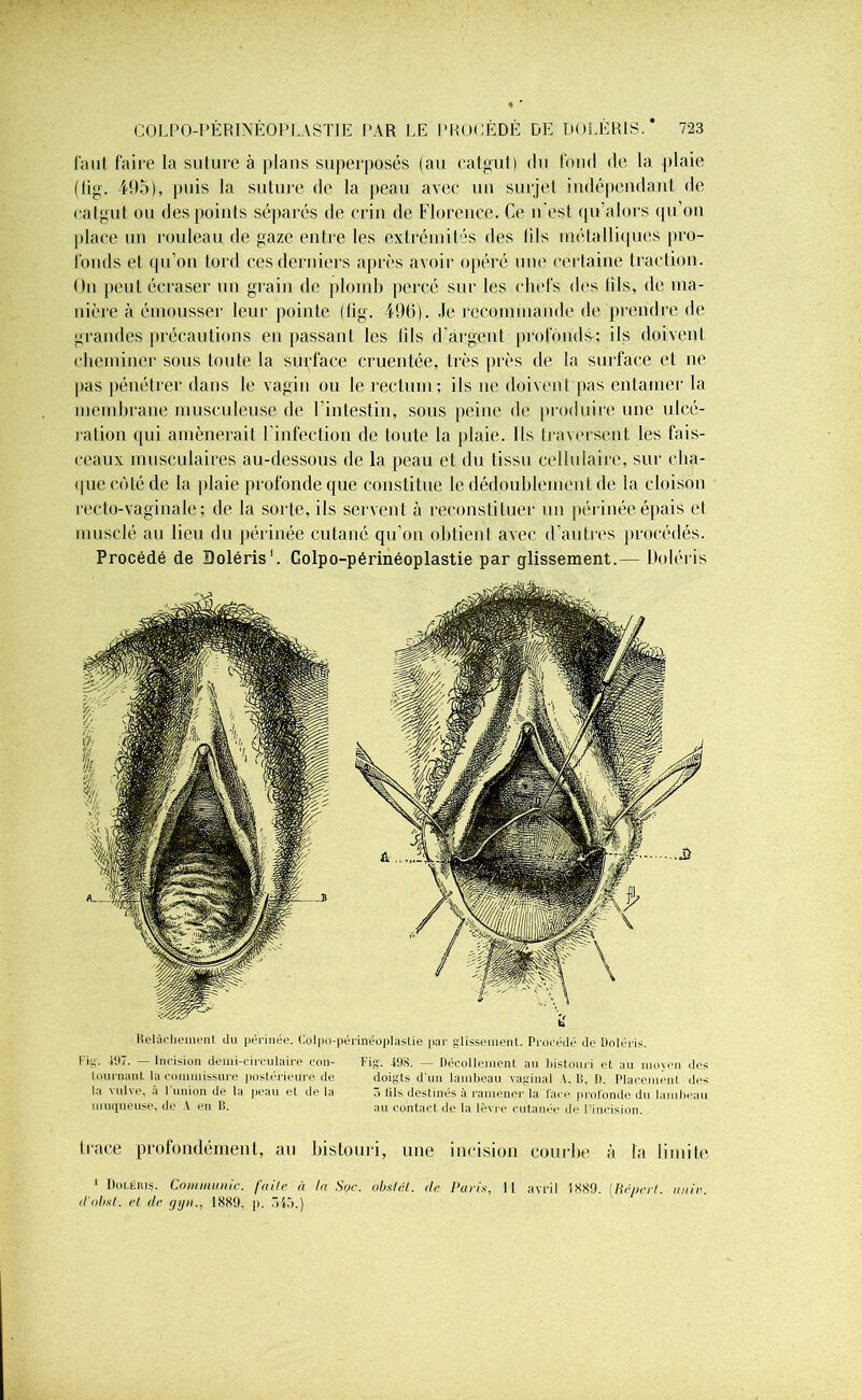 faut faire la suture à plans superposés (au catgut) du fond de la plaie (lig. 495), puis la suture de la peau avec un surjet indépendant de catgut ou des points séparés de crin de Florence. Ce n'est qu’alors qu’on place un rouleau de gaze entre les extrémités des lils métalliques pro- fonds et qu’on tord ces derniers après avoir opéré une certaine traction. On peut écraser un grain de plomb percé sur les chefs des lils, de ma- nière à émousser leur pointe (lig. 496). Je recommande de prendre de grandes précautions en passant les (ils d’argent profonds-; ils doivent cheminer sous toute la surface cruentée, très près de la surface et ne pas pénétrer dans le vagin ou le rectum; ils ne doivent pas entamer la membrane musculeuse de l’intestin, sous peine de produire une ulcé- ration qui amènerait l'infection de toute la plaie. Ils traversent les fais- ceaux musculaires au-dessous de la peau et du tissu cellulaire, sur cha- que coté de la plaie profonde que constitue le dédoublement de la cloison recto-vaginale; de la sorte, ils servent à reconstituer un périnée épais et musclé au lieu du périnée cutané qu’on obtient avec d’autres procédés. Procédé de Doléris1. Golpo-périnéoplastie par glissement.— Doléris Relâchement du périnée. Colpo-périnéoplastie par glissement. Procédé de Doléris. Fig. -197. — Incision demi-circulaire con- tournant la commissure postérieure de la vulve, à l’union de la peau et de la muqueuse, de A en B. Fig. 198. — Décollement au bistouri et au moyen des doigts d’un lambeau vaginal A. B, 1). Placement des ô lils destinés à ramener la face profonde du lambeau au contact de la lèvre cutanée de I incision. trace profondément, au bistouri, une incision courbe à la limite 1 Doléris. Communie, faite à la Soc. obstét. (le, Paris, Il avril 1889. [Réperl. unie, d'obsl. et de (jijn.. 1889. p. Ô45.)