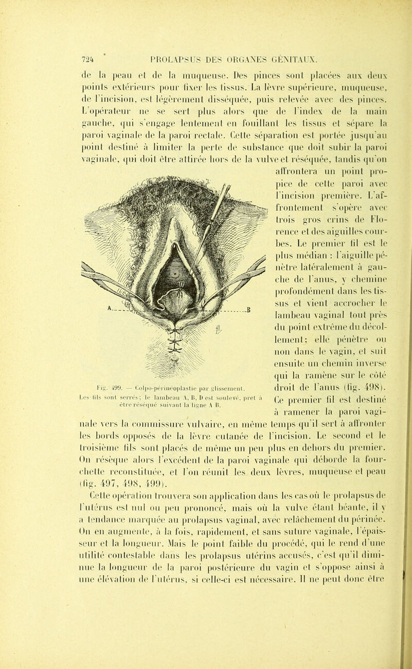 de la peau et de la muqueuse. Des pinces sont placées aux deux points extérieurs pour fixer les tissus. La lèvre supérieure, muqueuse, de I incision, esl légèrement disséquée, puis relevée avec des pinces. L opérateur ne se sert plus alors que de l'index de la main gauche, qui s’engage lentement en fouillant les tissus et sépare la paroi vaginale de la paroi rectale. Cette séparation est portée jusqu’au point destiné à limiter la perte de substance que doit subir la paroi vaginale, qui doit être attirée hors de la vulve et réséquée, tandis qu’on affrontera un point pro- pice de celle paroi avec l’incision première. L’af- frontement s'opère avec trois gros crins de Flo- rence et des aiguilles com - bes. Le premier lil est le plus médian : l’aiguille pé- nètre latéralement à gau- che de l’anus, y chemine profondément dans les tis- sus et vient accrocher le lambeau vaginal tout près dui point extrême du décol- lement: elle pénètre ou non dans le vagin, et suit ensuite un chemin inverse qui la ramène sur le côté droit de l’anus (fig. 498). Ce premier fil est destiné à ramener la paroi vagi- nale vers la commissure vulvaire, en même temps qu il sert à affronter les bords opposés de la lèvre cutanée de l’incision. Le second et le troisième fils sont placés de môme un peu plus en dehors du premier. On résèque alors l’excédent delà paroi vaginale qui déborde la four- chette reconstituée, el l'on réunit les deux lèvres, muqueuse et peau (fig. 497, 498, 499). Cette opération trouvera son application dans les cas où le prolapsus de I utérus est nul ou peu prononcé, mais où la vulve étant béante, il y a tendance marquée au prolapsus vaginal, avec relâchement du périnée. On en augmente, à la fois, rapidement, et sans suture vaginale, l'épais- seur et la longueur. Mais le point faible du procédé, qui le rend d’une utilité contestable dans les prolapsus utérins accusés, c’est qu il dimi- nue la longueur de la paroi postérieure du vagin et s’oppose ainsi à une élévation de l'utérus, si celle-ci est nécessaire. 11 ne peut donc être l'ig. 199. — Colpo-périnéoplastie par glissement. Les lils sont serrés; le lambeau \, B, Best soulevé, prêt à être réséqué suivant la ligne A B.