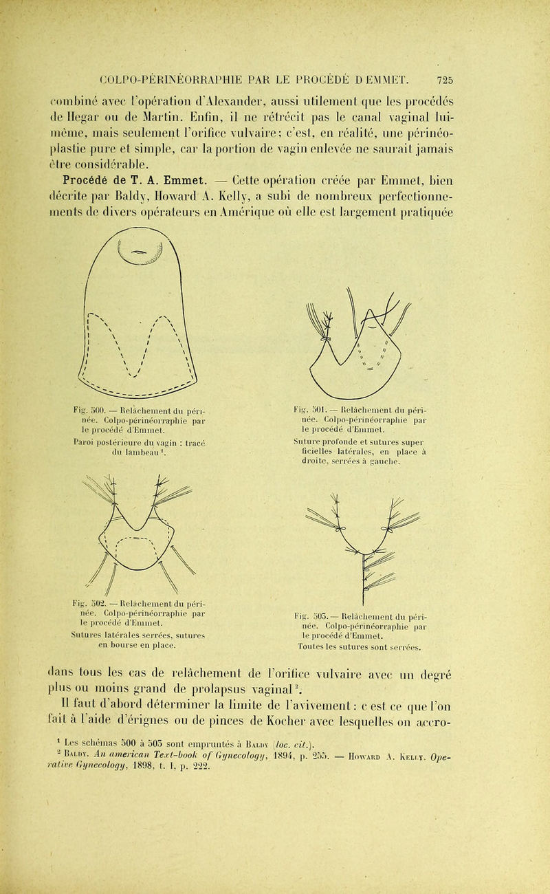 combiné avec l’opération d’Alexander, aussi utilement que les procédés de Ilegar ou de Martin. Enfin, il ne rétrécit pas le canal vaginal lui- inème, mais seulement l’orifice vulvaire; c’est, en réalité, une périnéo- plastie pure et simple, car la portion de vagin enlevée ne saurait jamais être considérable. Procédé de T. A. Emmet. — Cette opération créée par Emmet, bien décrite par Baldv, Howard A. Kelly, a subi de nombreux perfectionne- ments de divers opérateurs en Amérique où elle est largement pratiquée Fig. oOO. — Relâchement du péri- née. Colpo-périnéorraphie par le procédé d’Emmet. Paroi postérieure du vagin : tracé du lambeau *. Fig. 302. — Relâchement du péri- née. Colpo-périnéorraphie par le procédé d’Emmet. Sutures latérales serrées, sutures en bourse en place. Fig. 501. — Relâchement du péri- née. Colpo-périnéorraphie par le procédé d’Emmet. Suture profonde et sutures super ficielles latérales, en place à droite, serrées à gauche. Fig. 505.— Relâchement du péri- née. Colpo-périnéorraphie par le procédé d’Emmet. Toutes les sutures sont serrées. dans tous les cas de relâchement de l’orifice vulvaire avec un degré plus ou moins grand de prolapsus vaginal2. Il faut d’abord déterminer la limite de l’avivement: c est ce que l’on fait à l’aide d’érignes ou de pinces de Rocher avec lesquelles ou accro- 1 Les schémas 500 à 505 sont empruntés à Baliiy (/oc. cit.). - Baldy. An american Teæl-booh of Gynecologij, 1894, p. 255. — Howahd A. Krli.y. Ope- ralive Gynecologij, 1898, t. I, p. 222.