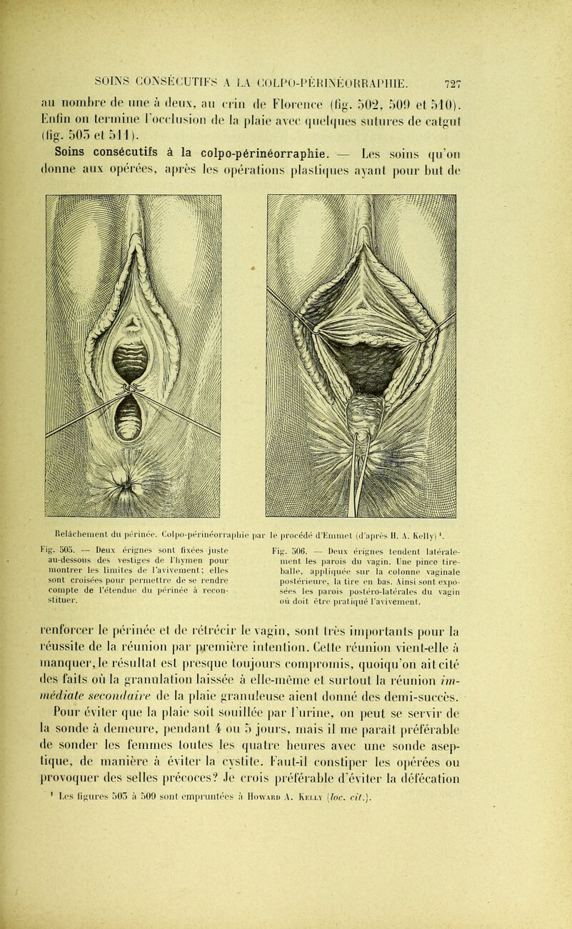 SOINS CONSÉCUTIFS A LA COLPO-PÊHINÉORRAPH1E. au nombre de une à deux, au crin de Florence (fïg. 502, 509 et 510). Enfui on termine 1 occlusion de la plaie avec quelques sutures de catgut (fig. 505 et 511 ). Soins consécutifs à la colpo-périnéorraphie. — Les soins qu’on donne aux opérées, après les opérations plastiques ayant pour but de Relâchement du périnée. Colpo-périnéorraphie Fig. 503. — Deux érignes sont fixées juste au-dessous des vestiges de l'hvmen pour montrer les limites de l'avivement; elles sont croisées pour permettre de se rendre compte de l’étendue du périnée à recon- stituer. par le procédé d’iimmet (d’après H. A. Kelly) '. Fig. 506. — Deux érignes tendent latérale- ment les parois du vagin. Une pince tire- balle, appliquée sur la colonne vaginale postérieure, la lire en bas. Ainsi sont expo- sées les parois postéro-latérales du vagin où doit être pratiqué l'avivement. renforcer le périnée et de rétrécir le vagin, sont 1res importants pour la réussite de la réunion par première intention. Celte réunion vient-elle à manquer, le résultat esl presque toujours compromis, quoiqu’on ait cité des faits où la granulation laissée à elle-même et surtout la réunion im- médiate secondaire de la plaie granuleuse aient donné des demi-succès. Pour éviter que la plaie soit souillée par l'urine, on peut se servir de la sonde à demeure, pendant 4 ou 5 jours, mais il me paraît préférable de sonder les femmes toutes les quatre heures avec une sonde asep- tique, de manière à éviter la cystite. Faut-il constiper les opérées ou provoquer des selles précoces? Je crois préférable d’éviter la défécation ’ I.cs figures 503 à 509 sont empruntées h Howard A. Kelly [toc. cil.).