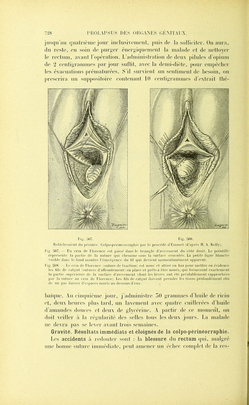 jusqu’au quatrième jour inclusivement, puis de la solliciter. On aura, du reste, eu soin de purger énergiquement la malade et de nettoyer le rectum, avant l’opération. L’administration de deux pilules d’opium de 2 centigrammes par jour suffit, avec la demi-diète, pour empêcher les évacuations prématurées. S il survient un sentiment de besoin, on prescrira un suppositoire contenant 10 centigrammes d’extrait tlié- Fig. 507. Fig. 508. Itelàchement du périnée. Colpo-périnéorraphie par le procédé d'Emmet (d'après H. A. Kelly). Fig. 507. — Un crin de Florence est passé dans le triangle d'avivement du coté droit. Le pointillé représente la partie de la suture qui chemine sous la surface cruentée. La petite ligne blanche visible dans le fond montre l’émergence du 111 qui devient momentanément apparent. Fig. 508. — Le crin de Florence (suture de traction) est noué et attiré en bas pour mettre en évidence les fils de catgut (sutures d'affrontement) en place et prêts à être noués, qui fermeront exactement la partie supérieure de la surface d’avivement (dont les lèvres ont été préalablement rapprochées par la suture au crin de Florence). Les fils de catgut doivent prendre les tissus profondément afin de ne pas laisser d'espaces morts au dessous d’eux. baïque. Au cinquième jour, j’administre 50 grammes d’huile de ricin <‘t, deux heures plus tard, un lavement avec quatre cuillerées d’huile d’amandes douces et deux de glycérine. A partir de ce moment, on doit veiller à la régularité des selles tous les deux jours. La malade ne devra pas se lever avant trois semaines. Gravité. Résultats immédiats et éloignés de la colpo-périnéorraphie. Les accidents à redouter sont : la blessure du rectum qui, malgré une bonne, suture immédiate, peut amener un échec complet de la res-