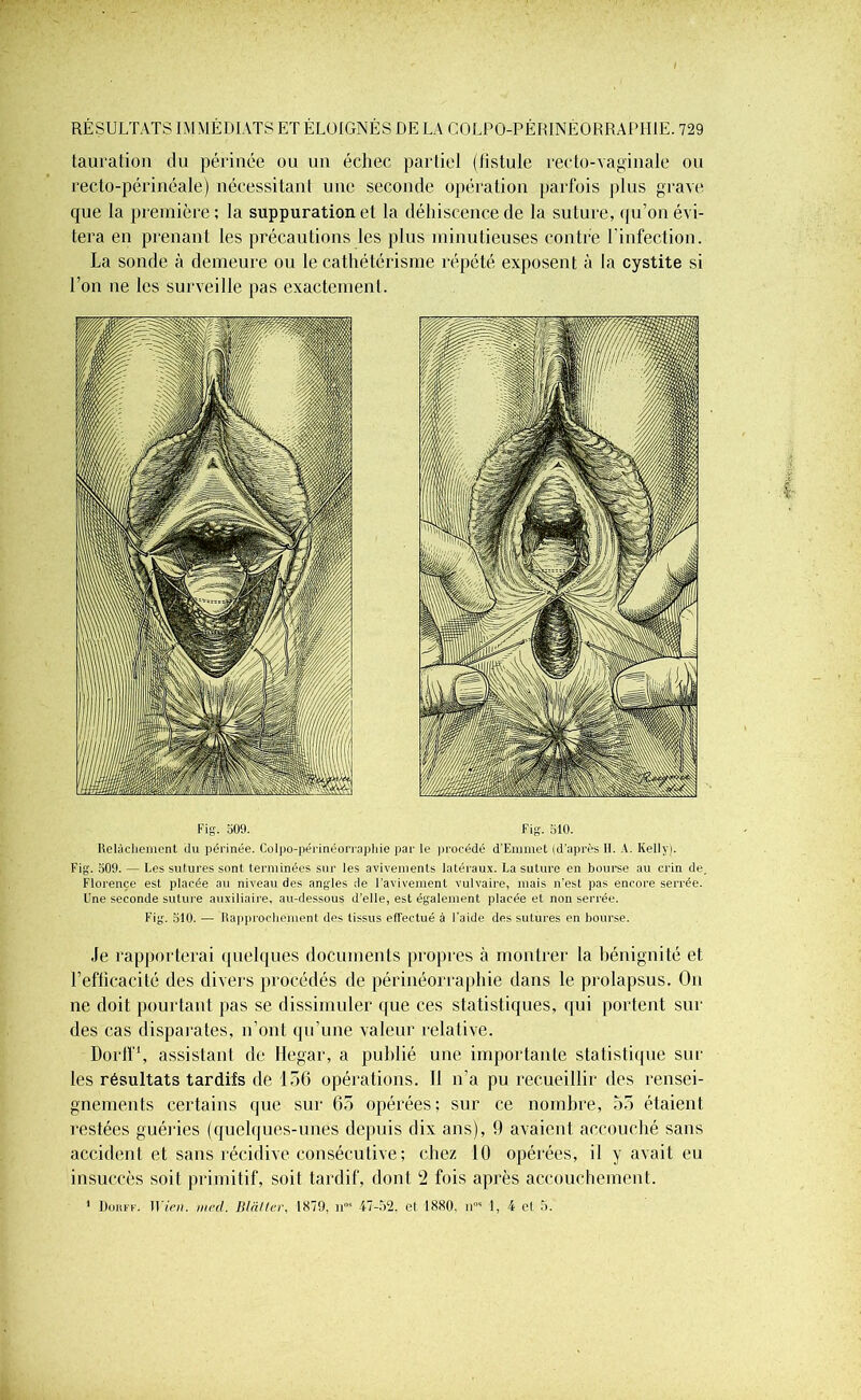 tauration du périnée ou un échec partiel (fistule recto-vaginale ou recto-périnéale) nécessitant une seconde opération parfois plus grave que la première; la suppuration et la déhiscence de la suture, qu’on évi- tera en prenant les précautions les plus minutieuses contre l’infection. La sonde à demeure ou le cathétérisme répété exposent à la cystite si l’on ne les surveille pas exactement. Fig. 509. Fig. 510. Relâchement du périnée. Colpo-pétinéonaphie par le procédé d'Emmet (d’après 11. A. Kelly). Fig. 509. — Les sutures sont terminées sur les avivements latéraux. La suture en bourse au crin de, Florence est placée au niveau des angles de l'avivement vulvaire, mais n'est pas encore serrée. Une seconde suture auxiliaire, au-dessous d'elle, est également placée et non serrée. Fig. 510. — Rapprochement des tissus effectué à l’aide des sutures en bourse. Je rapporterai quelques documents propres à montrer la bénignité et l’efficacité des divers procédés de périnéorraphie dans le prolapsus. On ne doit pourtant pas se dissimuler que ces statistiques, qui portent sur des cas disparates, n’ont qu’une valeur relative. Dorff1, assistant de llegar, a publié une importante statistique sui- tes résultats tardifs de 156 opérations. Il n’a pu recueillir des rensei- gnements certains que sur 65 opérées; sur ce nombre, 55 étaient restées guéries (quelques-unes depuis dix ans), 9 avaient accouché sans accident et sans récidive consécutive ; chez 10 opérées, il y avait eu insuccès soit primitif, soit tardif, dont 2 fois après accouchement. 1 Üohff. IFien. med. Blàttcr, 1S79, il05 47-52. et 1880. n”5 1, 4 et 5.