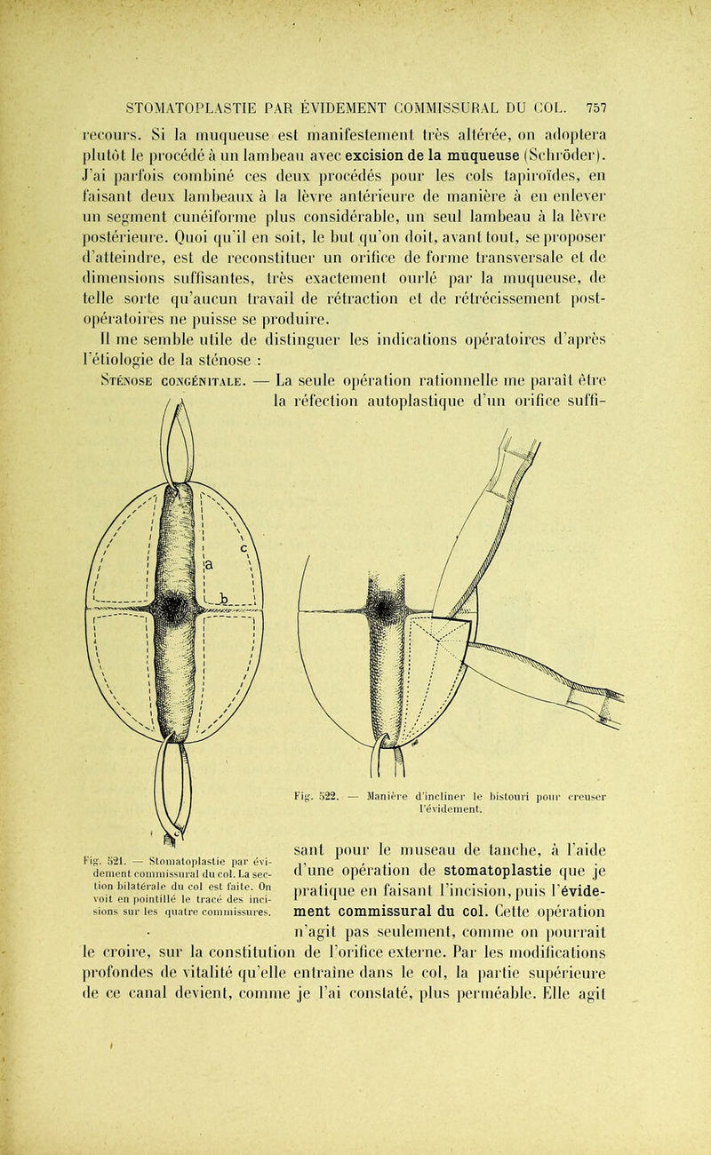 recours. Si la muqueuse est manifestement très altérée, on adoptera plutôt le procédé à un lambeau avec excision de la muqueuse (Scbrôder). J’ai parfois combiné ces deux procédés pour les cols tapiroïdes, en faisant deux lambeaux à la lèvre antérieure de manière à en enlever un segment cunéiforme plus considérable, un seul lambeau à la lèvre postérieure. Quoi qu’il en soit, le but qu’on doit, avant tout, se proposer d’atteindre, est de reconstituer un orifice de forme transversale et de dimensions suffisantes, très exactement ourlé par la muqueuse, de telle sorte qu’aucun travail de rétraction et de rétrécissement post- opératoires ne puisse se produire. Il me semble utile de distinguer les indications opératoires d’après l’étiologie de la sténose : Sténose congénitale. — La seule opération rationnelle me paraît être la réfection autoplastique d’un orifice suffî- Fig. 522. — Manière d'incliner le bistouri pour creuser l’évidement. saut pour le museau de tanche, à l’aide d’une opération de stomatoplastie que je pratique en faisant l’incision, puis l'évide- ment commissural du col. Cette opération n’agit pas seulement, comme on pourrait le croire, sur la constitution de l’orifice externe. Par les modifications profondes de vitalité qu’elle entraîne dans le col, la partie supérieure de ce canal devient, comme je l’ai constaté, plus perméable. Elle agit Fig. 521. — Stomatoplastie par évi- dement commissural du col. La sec- tion bilatérale du col est faite. On voit en pointillé le tracé des inci- sions sur les quatre commissures.