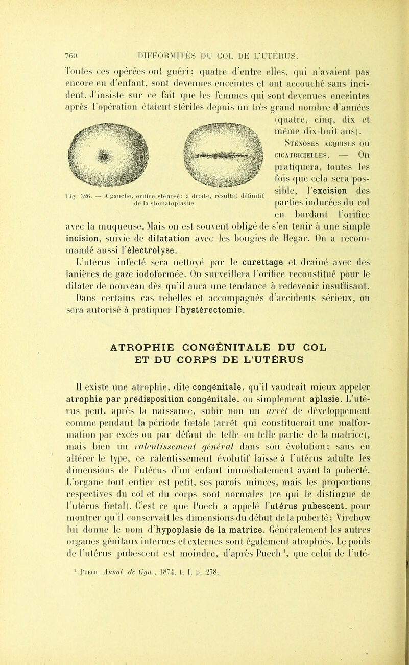 Toutes ces opérées ont guéri; quatre d’entre elles, qui n'avaient pas encore eu d’enfant, sont devenues enceintes et ont accouché sans inci- dent. .1 insiste sur ce fait que les femmes qui sont devenues enceintes après l’opération étaient stériles depuis un 1res grand nombre d’années (quatre, cinq, dix et même dix-huit ans). Stéxoses acquises ou CICATRICIELLES. ■ Oll pratiquera, toutes les fois que cela sera pos- sible, l’excision des parties indurées du col en bordant l’orifice avec la muqueuse. Mais on est souvent obligé de s'en tenir à une simple incision, suivie de dilatation avec les bougies de Hegar. On a recom- mandé aussi l’électrolyse. L’utérus infecté sera nettoyé par le curettage et drainé avec des lanières de gaze iodoformée. On surveillera l’orifice reconstitué pour le dilater de nouveau dès qu’il aura une tendance à redevenir insuffisant. Dans certains cas rebelles et accompagnés d’accidents sérieux, on sera autorisé à pratiquer l’hystérectomie. Fi. 526. A gauche, orifice sténosé; à droite, résultat définitif de la stomatoplasfie. ATROPHIE CONGÉNITALE DU COL ET DU CORPS DE L’UTÉRUS Il existe une atrophie, dite congénitale, qu’il vaudrait mieux appeler atrophie par prédisposition congénitale, ou simplement aplasie. L'uté- rus peut, après la naissance, subir non un arrêt de développement comme pendant la période fœtale (arrêt qui constituerait une malfor- mation par excès ou par défaut de telle ou telle partie de la matrice), mais bien un ralentissement général dans son évolution; sans en altérer le type, ce ralentissement évolutif laisse à l'utérus adulte les dimensions de l’utérus d’un enfant immédiatement avant la puberté. L’organe tout entier est petit, ses parois minces, mais les proportions respectives du col et du corps sont normales (ce qui le distingue de l’utérus fœtal). C’est ce que Puech a appelé l’utérus pubescent, pour montrer qu’il conservait les dimensions du début delà puberté; Virchow lui donne le nom d’hypoplasie de la matrice. Généralement les autres organes génitaux internes et externes sont également atrophiés. Le poids de l’utérus pubescent est moindre, d’après Puech ‘, que celui de l'uté- Puech. Annal, de Gyn., 1874, t. I, p. ‘278.