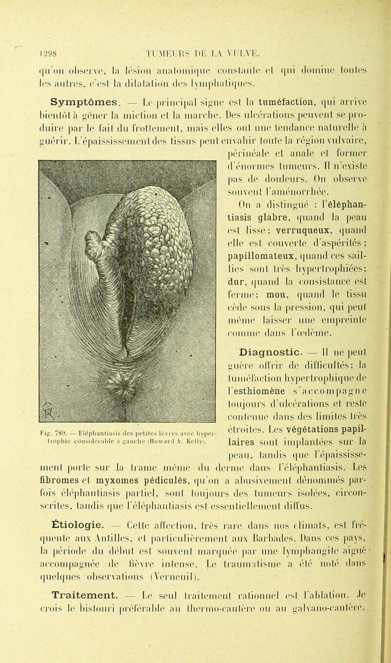 qu’on observe, la lésion anatomique conslanle (T qui doinine loules les antres, c est la dilatation des I vin plia l i ues. Symptômes. — Le principal signe est la tuméfaction, qui arrive bientôt à gêner la miction et la marche. Des ulcérations peuvent se pro- duire par le fait du frottement, mais elles ont une tendance naturelle à guérir. L’épaississement des tissus peut envahir toute la région vulvaire, périnéale et anale et former d'énormes tumeurs. Il n'existe pas de douleurs. On observe souvent l’aménorrhée. On a distingué : féléphan- tiasis glabre, quand la peau est lisse; verruqueux, quand elle est couverte d aspérités: papiilomateux, quand ces sail- lies sont très hypertrophiées; dur, quand la consistance est ferme; mou, quand le tissu cède sous la pression, qui peut même laisser une empreinte comme dans l’œdème. Diagnostic. — Il ne peut guère olfrir de difficultés; la tuméfaction hypertrophique de l esthiomène s’aceompagn e toujours d’ulcérations et reste contenue dans des limites très étroites. Les végétations papil- laires sont implantées sur la peau, tandis que l’épaississe- ment porte sur la trame même du derme dans I’éléphantiasis. Les fibromes et myxomes pédiculés, qu’on a abusivement dénommés par- fois éléphanliasis partiel, sont toujours des tumeurs isolées, circon- scrites, tandis que l’éléphanliasis est essentiellement diffus. Étiologie. — Celle affection, très rare dans nos ( limais, est fré- quente aux Antilles, et particulièrement aux Barbades. Dans ces pays, la période du début est souvent marquée par une lymphangite aiguë accompagnée de fièvre intense. Le traumatisme a été noté dans quelques observations (Verneuil). Traitement. — Le seul traitement rationnel est l’ablation, .le crois le bistouri préférable au thermo-cautère ou au galvano-cautère.