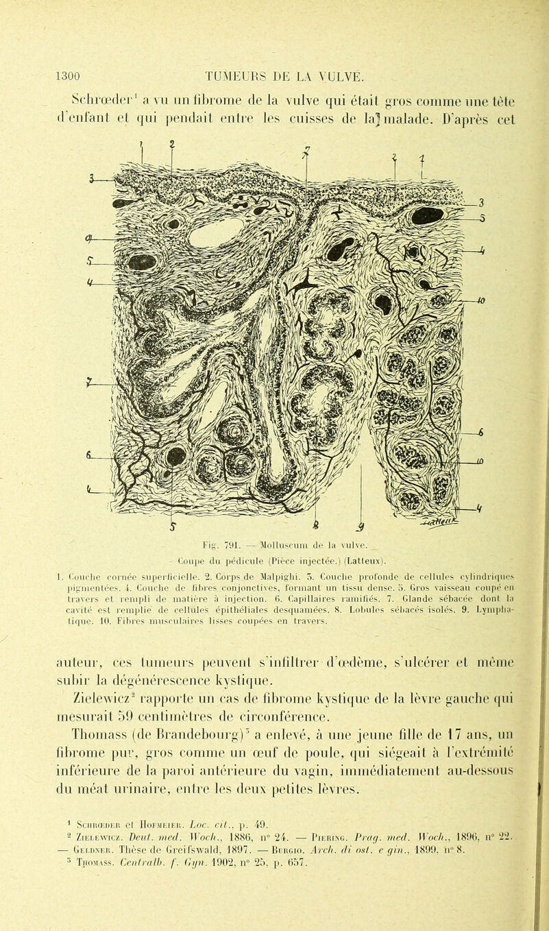 Schrœder' a mi un fibrome de la vulve qui était gros comme une tète d’enfant et qui pendait entre les cuisses de la] malade. D’après cet Fig. 791. — Molluscum île la vulve. Coupe du pédicule (Pièce injectée.) (Latleux). 1. l ouche cornée superficielle. 2. Corps.de Malpiglii. 5. Couche profonde de cellules cylindriques pigmentées, i. Couche de libres conjonctives, formant un tissu dense, b. Gros vaisseau coupé en travers et rempli de matière à injection. 6. Capillaires ramifiés. 7. Glande sébacée dont la cavité est remplie de cellules épithéliales desquamées. S. Lobules sébacés isolés. 9. Lympha- tique. 10. Fibres musculaires li-ses coupées en travers. auteur, ces tumeurs peuvent s’infiltrer d’œdème, s’ulcérer et même subir la dégénérescence kystique. Zielewicz1 2 l'apporte un cas de fibrome kystique de la lèvre gauche tpii mesurait 59 centimètres de circonférence. Thomass (de Brandebourg)3 a enlevé, à une jeune fille de 17 ans, un fibrome pur, gros comme un œuf de poule, qui siégeait à l’extrémité inférieure de la paroi antérieure du vagin, immédiatement au-dessous du méat urinaire, entre les deux petites lèvres. 1 SœnrnoER et Hofsieieh. Loc. cil., p. 49. - Zielewicz. Dent. med. Woch., 183(3, n° 24. — I’iebing. Prag. med. Woch., 1896, n° ‘22. — Geldker. Thèse do Grei'fswald, 3897. —Kciigio. Arch. di ost. e gin.. 1899. n 8. 3 Tiiomvss. Centralb. f. Ciyn. 190‘2, n° 25, p. 657.