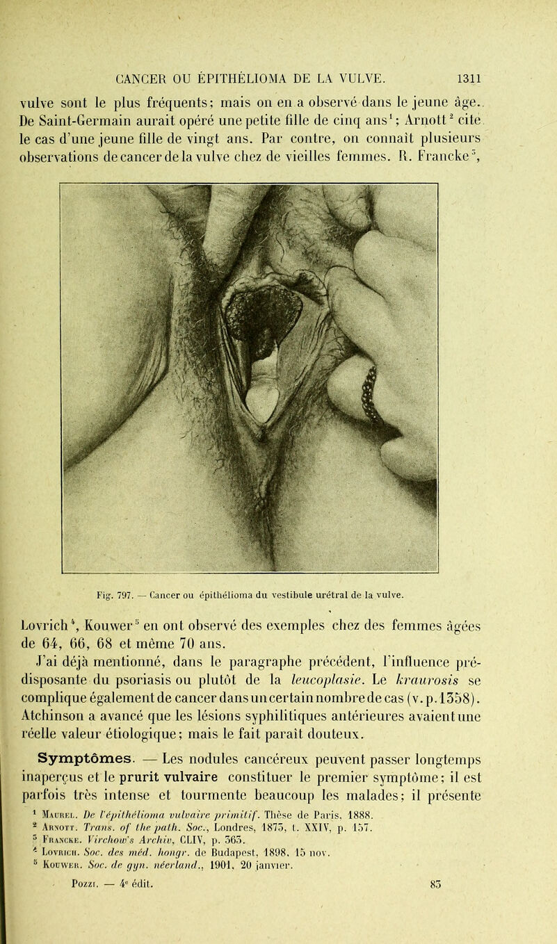 vulve sont le plus fréquents; mais on en a observé dans le jeune âge. De Saint-Germain aurait opéré une petite fille de cinq ans1; Arnott2 cite le cas d’une jeune fille de vingt ans. Par contre, on connaît plusieurs observations de cancer de la vulve chez de vieilles femmes. R. Franche3, Fig. 797. — Cancer ou épithélioma du vestibule urétral de la vulve. Lovrich\ Kouwer5 en ont observé des exemples chez des femmes âgées de 64, 66, 68 et même 70 ans. J’ai déjà mentionné, dans le paragraphe précédent, l’influence pré- disposante du psoriasis ou plutôt de la leucoplasie. Le kraurosis se complique également de cancer dans un certain nombre de cas ( v. p. 1358). Atchinson a avancé que les lésions syphilitiques antérieures avaient une réelle valeur étiologique; mais le fait paraît douteux. Symptômes. — Les nodules cancéreux peuvent passer longtemps inaperçus et le prurit vulvaire constituer le premier symptôme; il est parfois très intense et tourmente beaucoup les malades; il présente 1 Maurf.l. De l’épithélioma vulvaire primitif. Thèse de Paris, 1888. 2 Arnott. Tram, of thepath. Soc., Londres, 1875, t. XXIV, p. 157. 5 Franche. Virchow's Archiv, CLIV, p. 365. 4 Lovnrcii. Soc. des mêd. hongr. de Budapest, 1898, 15 nov. 5 Kouwer. Soc. de gyn. néerland., 1901. 20 janvier. Pozzr. — 4e édit. 85