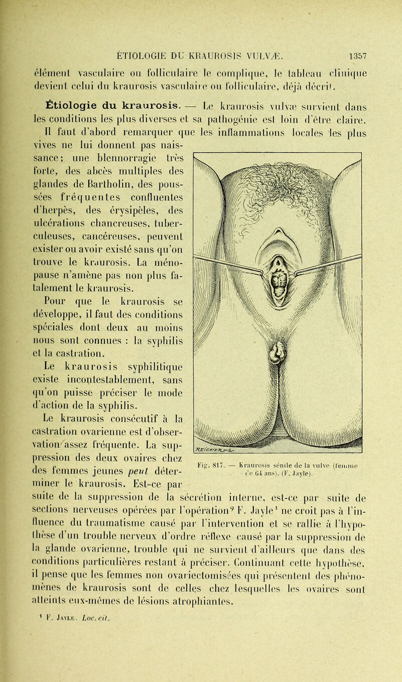 élément vasculaire ou folliculaire le complique, le tableau clinique devient celui du kraurosis vasculaire ou folliculaire, déjà décrit. Étiologie du kraurosis. — Le kraurosis vulvæ survient dans les conditions les plus diverses et sa pathogénie esl loin detre claire. Il faut d’abord remarquer que les inflammations locales les plus vives ne lui donnent pas nais- sance ; une blennorragie très forte, des abcès multiples des glandes de Bartholin, des pous- sées fréquentes confluentes d’herpès, des érysipèles, des ulcérations chancreuses, tuber- culeuses, cancéreuses, peuvent exister ou avoir existé sans qu’on trouve le kraurosis. La méno- pause n’amène pas non plus fa- talement le kraurosis. Pour que le kraurosis se développe, il faut des conditions spéciales dont deux au moins nous sont connues : la syphilis et la castration. Le kraurosis syphilitique existe incontestablement, sans qu’on puisse préciser le mode d’action de la syphilis. Le kraurosis consécutif à la castration ovarienne est d’obser- vation'assez fréquente. La sup- pression des deux ovaires chez des femmes jeunes peut déter- miner le kraurosis. Est-ce par suite de la suppression de la sécrétion interne, est-ce par suite de sections nerveuses opérées par l’opération9 F. Jayle1 ne croit pas à l’in- fluence du traumatisme causé par l’intervention et se rallie à l’hypo- I lièse d’un trouble nerveux d’ordre réflexe causé par la suppression de la glande ovarienne, trouble qui ne survient d’ailleurs que dans des conditions particulières restant à préciser. Continuant cette hypothèse, il pense que les femmes non ovariectomisces qui présentent des phéno- mènes de kraurosis sont de celles chez lesquelles les ovaires sont atteints eux-mêmes de lésions atrophiantes. ’ F. Jayle. Luc. cil.