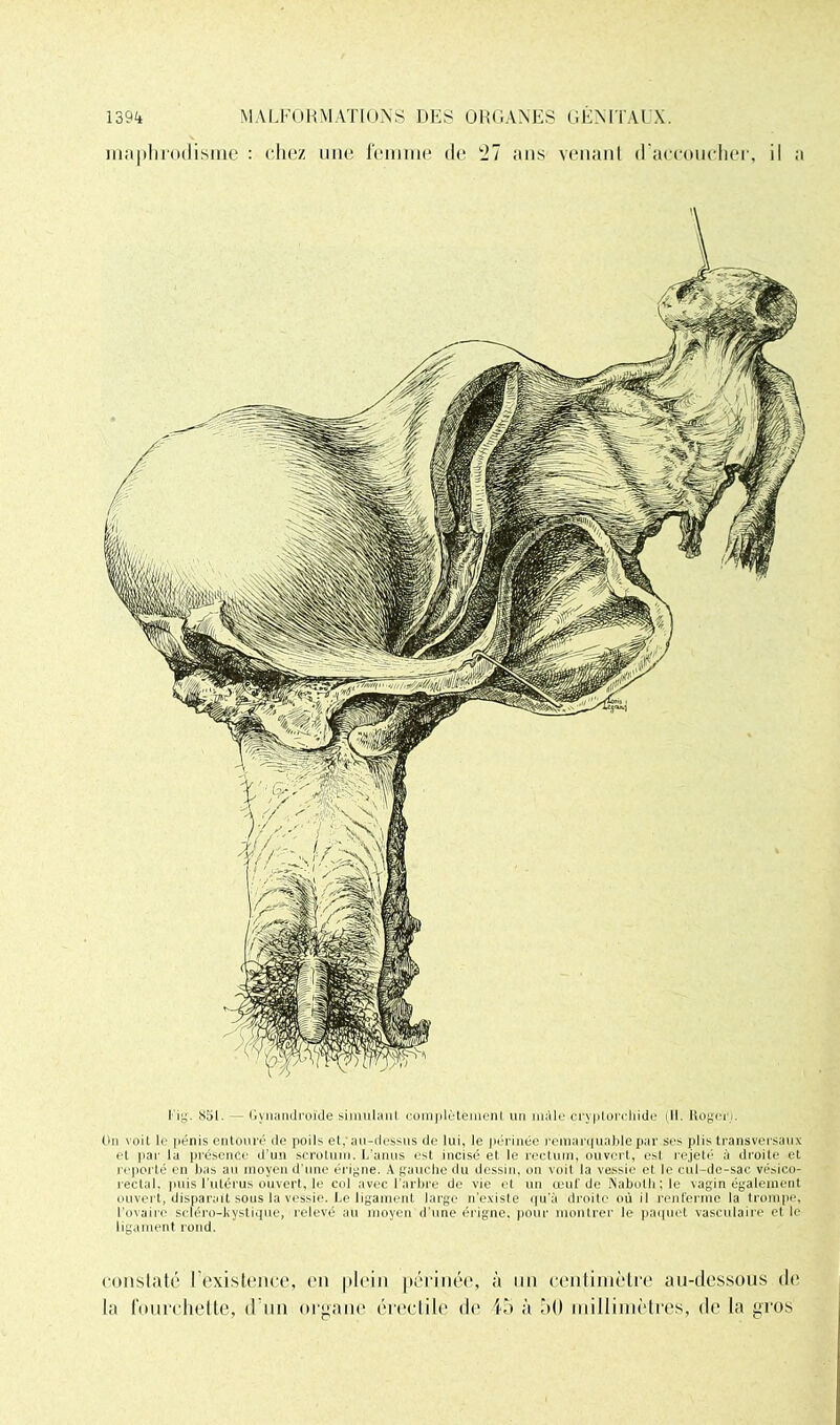 maplirodisme : chez une femme de 21 ans venant d'accoucher, il a Fig. 851. - Gynandroïde simulant complètement un mâle cryptorchide (11. Roger i. On voit le pénis entouré de poils et,* au-dessus de lui, le périnée remarquable par ses plis transversaux et par la présence d’un scrotum. L’anus est incisé et le rectum, ouvert, est rejeté à droite et reporté en bas au moyen d’une érigne. A gauche du dessin, on voit la vessie et le cul-de-sac vésico- rectal. puis l’utérus ouvert, le col avec l’arbre de vie et un œuf de Naboth ; le vagin également ouvert, disparait sous la vessie. Le ligament large n’existe qu’à droite où il renferme la trompe, l’ovaire scléro-kystique, relevé au moyen d’une érigne, pour montrer le paquet vasculaire et le ligament rond. constaté l'existence, en plein périnée, à un centimètre au-dessous de la fourchette, d'un organe érectile de là à è(> millimètres, de la gros
