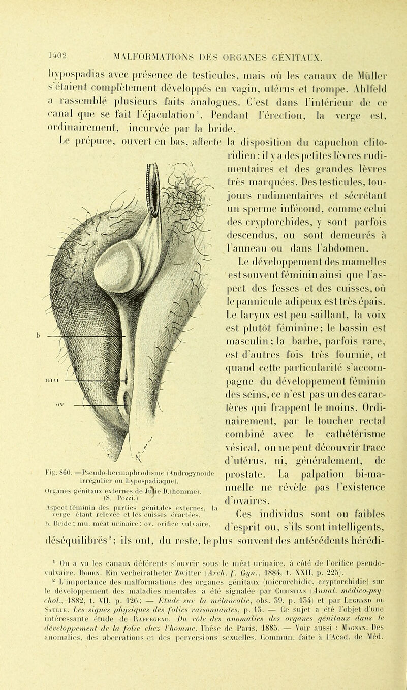 hypospadias avec présence de testicules, niais où les canaux de s élaient complètement développés en vagin, utérus et trompe. Alilfeld ;i rassemblé plusieurs faits analogues. L'est dans 1 intérieur de ce l'anal que se fait l’éjaculation1 2 * * * * * *. Pendant l’érection, la verge est, ordinairement, incurvée par la bride. Le prépuce, ouvert en bas, affecte Kig. 860. —Pseudo-hermaphrodisme (Amlrogynoïde irrégulier ou hypospadiaque). Organes génitaux externes de Ju»ie I).(homme). (S. Pozzi.) * Aspect féminin des parties génitales externes, la verge étant relevée et les cuisses écartées. I». Ih ide; mu. méat urinaire ; ov. orifice vulvaire. déséquilibrés9; la disposition du capuchon clilo- ridien : il va des petites lèvres rudi- mentaires et des grandes lèvres très marquées. Des testicules, tou- jours rudimentaires et sécrétant un sperme infécond, comme celui des crvptorchides, v sont parfois descendus, ou sont demeurés à l’anneau ou dans l’abdomen. Le développement des mamelles est souvent féminin ainsi que I as- pect des fesses et des cuisses,où lepannicule adipeux est très épais. Le larynx est peu saillant, la voix est plutôt féminine; le bassin est masculin ; la barbe, parfois rare, est d’autres fois très fournie, et quand celle particularité s’accom- pagne du développement féminin des seins, ce n’est pas un des carac- tères qui frappent le moins. Ordi- nairement, par le toucher rectal combiné avec le cathétérisme vésical, on ne peut découvrir trace d’utérus, ni, généralement, de prostate. La palpation bi-ma- nuelle ne révèle pas l’existence d’ovaires. Les individus sont ou faibles d’esprit ou, s'ils sont intelligents, ils ont, du reste, leplus souvent des antécédents hérédi- 1 On a vu les canaux déférents s’ouvrir sous le méat urinaire, à côté de l'orifice pseudo- vulvaire. Doiuin. Ein verheiratlieter Zwittor [Arch. f. Gyii.. 1884, t. XXII. ji. 225). 2 L'importance des malformations des organes génitaux (microrchidie, cryptorchidie) sur le développement, des maladies mentales a été signalée par Christian' Annal, médico-psy- ihol., 1882, t. VII, p. 126; — Élude sur lu mélancolie, obs. 59. p. 154) cl par Legrand du Sui.le. Les signes physiques (les folies raisonnantes, p. 15. — Ce sujet a été l’objet dune intéressante étude de Iïaffegeau. Du rôle des anomalies des organes génitaux dans le développement de la folie cita l'homme. Thèse de Paris, 1885. — Voir aussi : Magnan. Des anomalies, des aberrations et des perversions sexuelles. Commun, faite à l'Acad. do Méd.