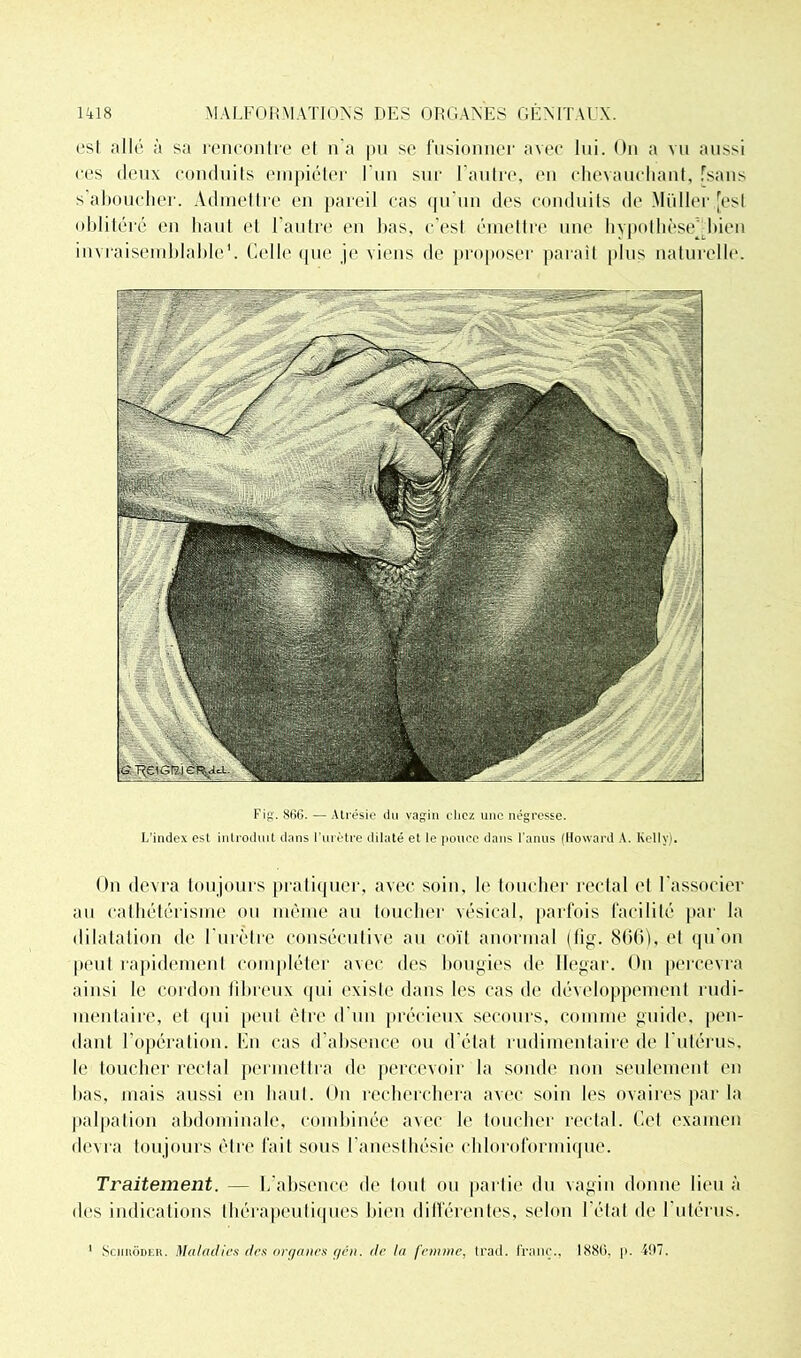 est allé à sa rencontre el n'a pu se fusionner avec lui. On a vu aussi ces deux conduits empiéter l'un sur l’autre, en chevauchant, [sans s’aboucher. Admettre en pareil cas qu’un des conduits de Millier [est oblitéré en liant et l’autre en bas, c'est émettre une hypothèse bien invraisemblable1. Celle que je viens de proposer parait plus naturelle. Fig'. 866. — Atrésie du vagin chez une négresse. L’index est introduit dans l’urètre dilaté et le pouce dans l’anus (Howard A. Kelly). On devra toujours pratiquer, avec soin, le toucher rectal et l'associer au cathétérisme ou même au toucher vésical, parfois facilité par la dilatation de l’urètre consécutive au coït anormal (tîg. 866), et qu'on peut rapidement compléter avec des bougies de Ilegar. On percevra ainsi le cordon fibreux qui existe dans les cas de développement rudi- mentaire, et qui peut être d'un précieux secours, comme guide, pen- dant l’opération. En cas d’absence ou d'état rudimentaire de l’utérus, le toucher rectal permettra de percevoir la sonde non seulement en bas, mais aussi en haut. On recherchera avec soin les ovaires par la palpation abdominale, combinée avec le toucher rectal. Cet examen devra toujours être fait sous l’anesthésie chloroformique. Traitement. — L’absence de tout ou partie du vagin donne lieu à des indications thérapeutiques bien différentes, selon l'état de l'utérus. 1 Sciihôder. Maladies des organes gén. de la femme, Irad. franc., 1886, p. 407.
