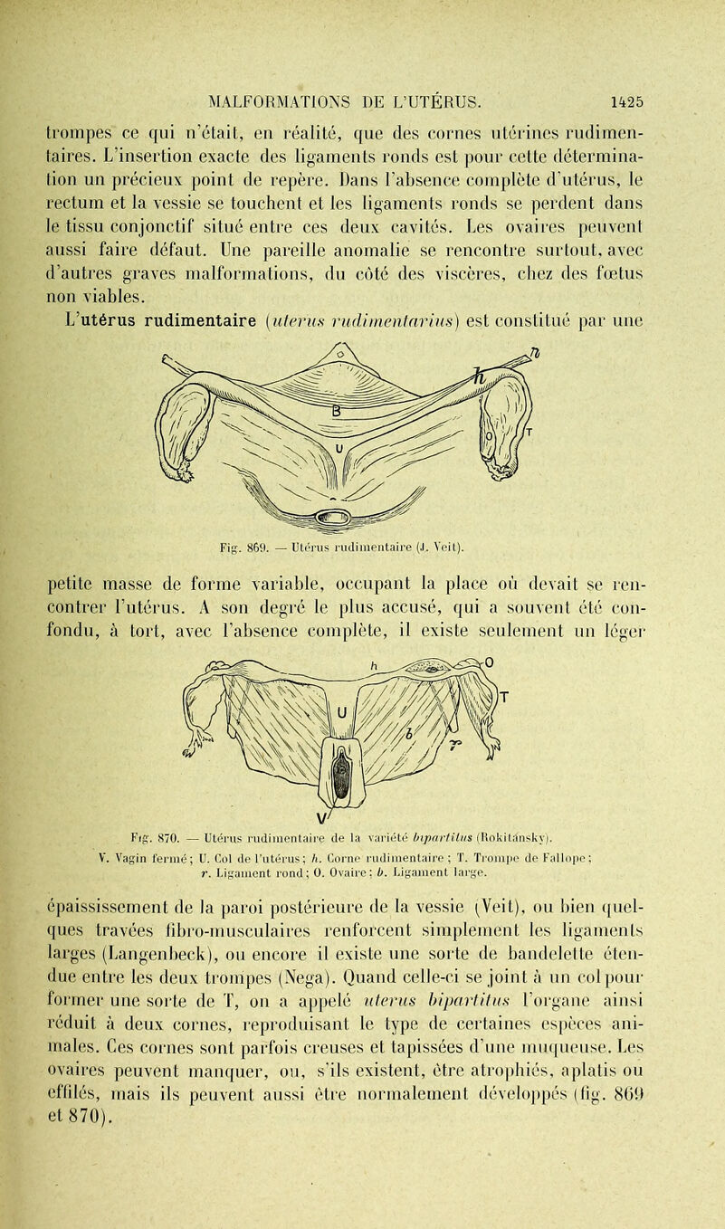 trompes ce qui n’était, en réalité, que des cornes utérines rudimen- taires. L’insertion exacte des ligaments ronds est pour cette détermina- tion un précieux point de repère. Dans l’absence complète d’utérus, le rectum et la vessie se touchent et les ligaments ronds se perdent dans le tissu conjonctif situé entre ces deux cavités. Les ovaires peuvent aussi faire défaut. Une pareille anomalie se rencontre surtout, avec d’autres graves malformations, du côté des viscères, chez des fœtus non viables. L’utérus rudimentaire (utérus vudimentarius) est constitué par une petite masse de forme variable, occupant la place où devait se ren- contrer l’utérus. A son degré le plus accusé, qui a souvent été con- fondu, à tort, avec l’absence complète, il existe seulement un léger V. Vagin fermé; U. Col de l’utérus; h. Corne rudimentaire; T. Trompe de Fallope; r. Ligament rond; O. Ovaire; b. Ligament large. épaississement de la paroi postérieure de la vessie (Veit), ou bien quel- ques travées libro-musculaires renforcent simplement les ligaments larges (Langenbeck), ou encore il existe une sorte de bandelette éten- due entre les deux trompes (Nega). Quand celle-ci se joint à un col pour former une sorte de T, on a appelé utérus biparti tus l’organe ainsi réduit à deux cornes, reproduisant le type de certaines espèces ani- males. Ces cornes sont parfois creuses et tapissées d’une muqueuse. Les ovaires peuvent manquer, ou, s'ils existent, être atrophiés, aplatis ou effilés, mais ils peuvent aussi être normalement développés (fig. 869 et 870).