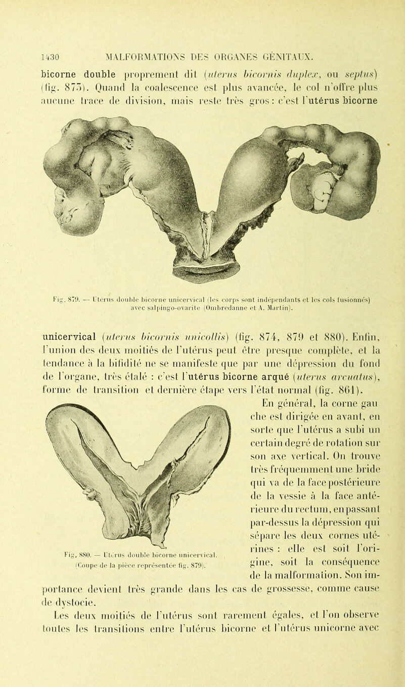 bicorne double proprement dit (utérus bicornis duplex, ou seplus) (fig. 8730 Quand la coalescence est plus avancée, le col n'offre plus aucune trace de division, mais reste très gros : c'est l'utérus bicorne Fig-. 879. — Utérus double bicorne unicervical (les corps sont indépendants et les cols fusionnés) avec salpingo-ovarite (Ombredanne et A. Martin). unicervical (utérus bicornis unicollis) (fig. 874, 87!) et 880). Enfin, I union des deux moitiés de l'utérus peut être presque complète, et la tendance à la bifidité ne se manifeste que par une dépression du fond de l’organe, très étalé : c'est l'utérus bicorne arqué (utérus arcuatus), forme de transition et dernière étape vers l'état normal (fig. 801). Fig, 880. — Utérus double bicorne unicervical. (Coupe de la pièce représentée fig. 879). portance de vieil I de dystocie. Les deux moitiés de l'utérus sont toutes les transitions En général, la corne gau che est dirigée en avant, en sorte que l'utérus a subi un certain degré de rotation sur son axe vertical. On trouve li és fréquemment une bride qui va de la face postérieure de la vessie à la face anté- rieure du rectum, en passant par-dessus la dépression qui sépare les deux cornes uté- rines : elle est soit l’ori- gine, soit la conséquence de la malformation. Son im- de grossesse, comme cause rarement égales, et l’on observe et l’utérus unicorne avec très grande dans les cas entre l’utérus bicorne