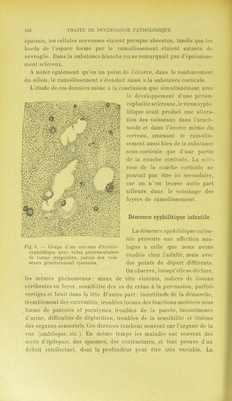 ■Ii02 TRAITE DE I'SYGLIOLOGIE PATH.0L0G1QUE epaissie, les cellules nerveuses elaient presque absentes, tandis que les bords de l’espace forme par le ramollissement elaient salures de nevroglie. Dans la substance blanche on ne remarquait pas d’epaissie- ment sclereux. A noter egalement qu’en un point de l’ecorce, dans le renfoncement du sillon, le ramollissement s’etendait aussi a la substance corlicale. L’etude de ces donnees mene a la conclusion que simultanement avec le developpement d’une perien- cephalile sclereuse, le virus syphi- litique avait produit une altera- tion des vaisseaux dans l’arach- no'i'de et dans l’ecorce meme du cerveau, amenant le ramollis- sement aussi bien de la substance sous-corticale que d'une partie de la couche corlicale. La scle- rose de la couche corticale ne pouvait pas etre ici secondaire, car on n’en trouve nulle part ailleurs dans le voisinage des foyers de ramollissement. Demence syphilitique infantile. La demence syphililique in fan- tile presente une affection ana- logue ii celle que nous avons etudiee chez l'adulte, mais avec des points de depart differents. On observe, lorsqu’elle se declare, les memes phenomenes : maux de tete violents, indices de lesions cerebrales en foyer, sensibilite des os du crime A la percussion, parfois vertiges el bruil dans la tete. D’aulre part: incertitude de la demarche, tremblemenl des exlremites, troubles locaux des fonclions molrices sous forme de paresies et paralysies, troubles de la parole, incontinence d’urine, difficuiles de deglutition, troubles de la sensibilite et lesions des organes seusoriels. Ces derniers tombent souvent sur l'organe de la vue (ambliopie, etc.). En mdme temps les malades ont souvent des acces d’epilepsie, des spasmes, des contractures, et font preuve d un deficit intellecluel, donl la profondeur pent etre Ires variable. La Fig. 9. — Coupe d un cerveau d’heredo- syphilitique avec vides perivasculaires de forme irreguli6re, parois des vais- seaux generalement epaissies.