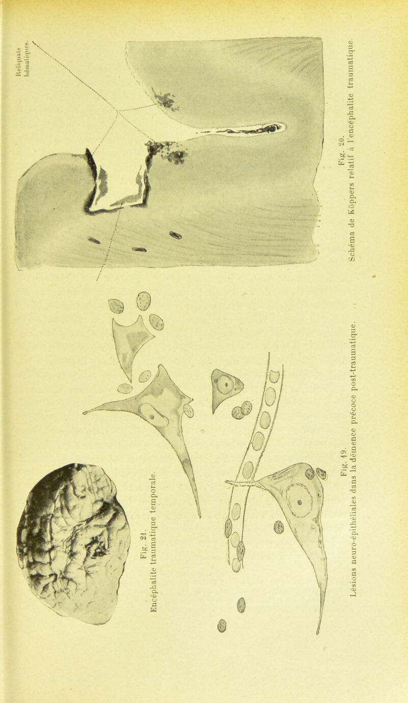 Holi<|uaLs li<§maliq»ies. Fig. 19. Fig. 20. Lesions neuro-epitheliales dans la demence precoce post-traumalique. Schema de lvOppers relalif a 1 encephalite traumatique