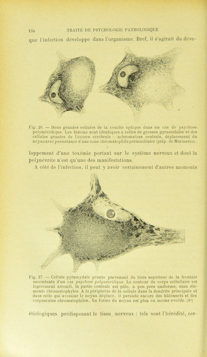 que l’infection developpe dans 1’organisme. Bref, il s’agirait du deve- Fig. 20. — Deux grandes cellules de la couche optique dans un cas de psychose polynevritique. Les lesions sont idenliques a celles de grosses pjTamidales et des cellules geantes de lecorce cerebrale : achromatose centrale, deplacement du noyauavecpersistance d'une zone chromatophile perinucleaire (prep. deMarinesco . loppement d’une toxemie portant sur le systeme nerveux et donl la polynevrile n’est qu’une des manifestations. A cote de 1’infection, il peul y avoir certainement d'aulres moments Fig. 27. — Cellule pyramydale geante provcnant du tiers superieur de la frontale ascendante d un cas psychose polynevrilique. Le contour du corps cellullaire est legcrement arrondi, la partie centrale est pale, a peu pres uniforme, sans ele- ments chromntophyles. A la peripherie de la cellule dans la dendrite principale et dans celle qui avoisine le noyau deplace, il persiste encore des balounets el des corpuscules chromatophiles. La forme du noyau est plug ou moins ovoide. (d°) etiologiques predisposanl. le lissu nerveux : tels sont l'lieredite, cer-