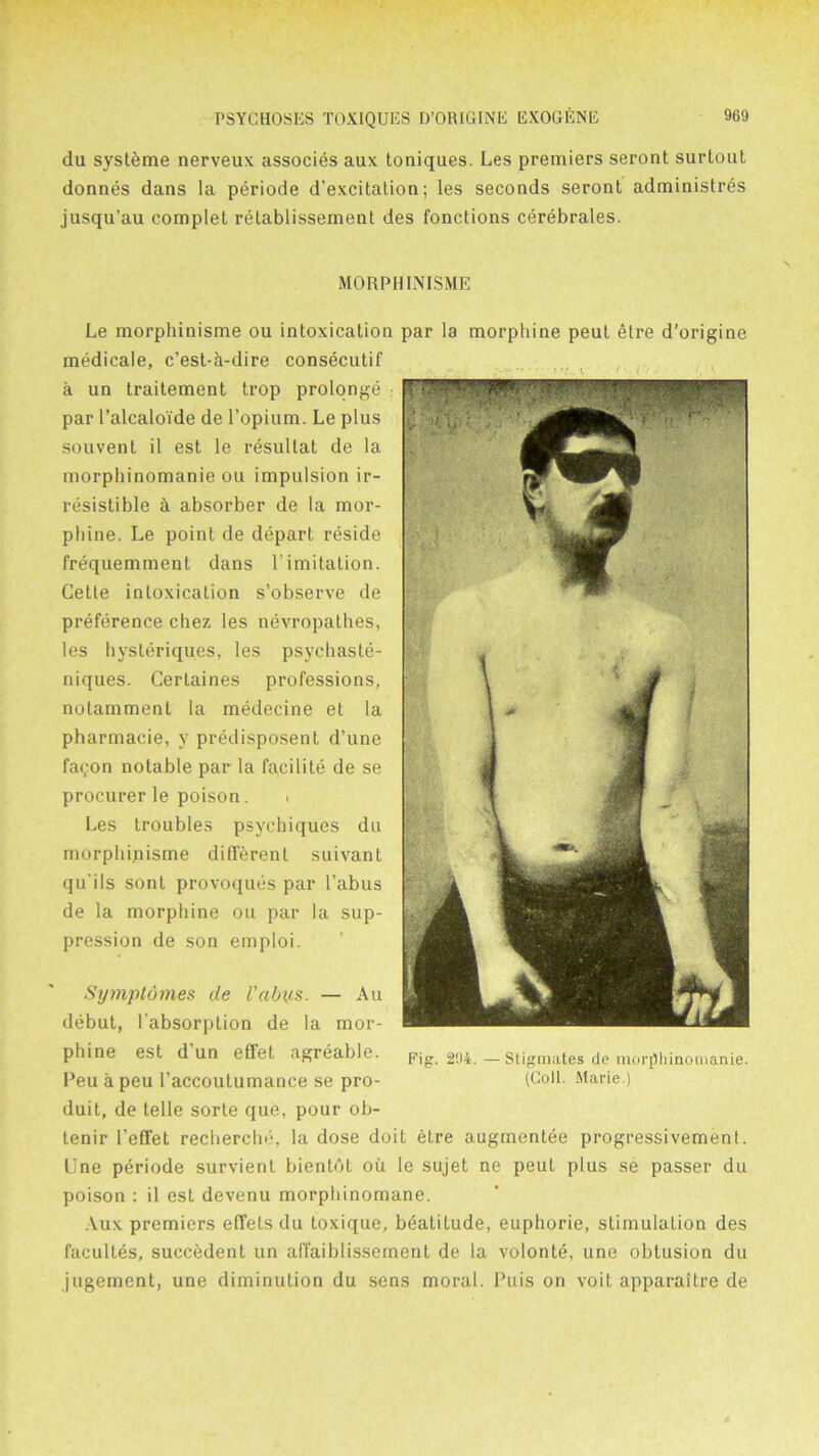 du systeme nerveux associes aux toniques. Les premiers seront surtout donnes dans la periode d’excitation; les seconds seront administres jusqu’au complet retablissement des fonctions cerebrales. MORPH INISME Le morphinisme ou intoxication par la morphine peut etre d'origine medicale, c’est-a-dire consecutif a un traitement trop prolonge par l’alcaloide de l’opium. Le plus souvent il est le resultat de la morphinomanie ou impulsion ir- resistible & absorber de la mor- phine. Le point de depart reside frequemment dans 1’imitation. Cette intoxication s’observe de preference chez les nevropathes, les hysleriques, les psychaste- niques. Cerlaines professions, notamment la medecine et la pharmacie, y predisposent d’une faqon notable par la facilite de se procurer le poison. . Les troubles psychiques du morphinisme different suivant qu'ils sont provoques par Tabus de la morphine ou par la sup- pression de son emploi. Symptomes de Vabvs■ — Au debut, l’absorption de la mor- phine est dun effet agreable. Fig. 294.—Stigmates de morphinomanie. Peu a peu l’accoutumance se pro- (Loll. Marie.) duit, de telle sorte que, pour ob- lenir 1’effet recherche, la dose doit etre augmentee progressivement. line periode survient bientot ou le sujet ne peut plus se passer du poison : il est devenu morphinomane. Aux premiers effets du toxique, beatitude, euphorie, stimulation des facultes, succedent un affaiblissement de la volont^, une obtusion du jugement, une diminution du sens moral. Puis on voit apparaitre de