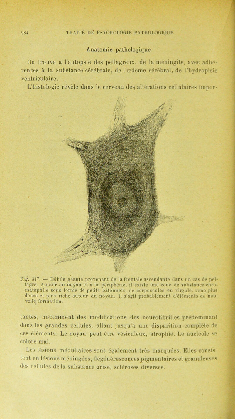 Fig. 317. — Cellule gdaute provenant de la frontale ascendante dans un cas de pc-1- lagre. Autour du noyau et a la peripherie, it existe une zone de substance chro- matophile sous forme de petils batonuets. de corpuscules en virgule. zone plus dense et plus riche autour du noyau, il s'agit probablement d'elements de nou- velle formation. tantes, notammenl des modifications des neurofibrilles predominant dans les grandes cellules, allant jusqu’a une disparition complete de ces elements. Le noyau peul etre vesiculeux, atrophic. Le nucleole se colore mal. Les lesions medullaires sont egalement Ires marquees. Elies consis- tent on lesions meningees, degcnerescences pigmentaires et granuleuses des cellules de la substance grise, scleroses diverses. Anatomie pathologique. On trouve i l’autopsie des pellagreux, de la meningile, a%rec adhe- rences a la substance cerebrate, de l’oedeme cerebral, de 1'bydropisie ventriculaire. L'histologie revele dans le cerveau des alterations cellulaires impor-