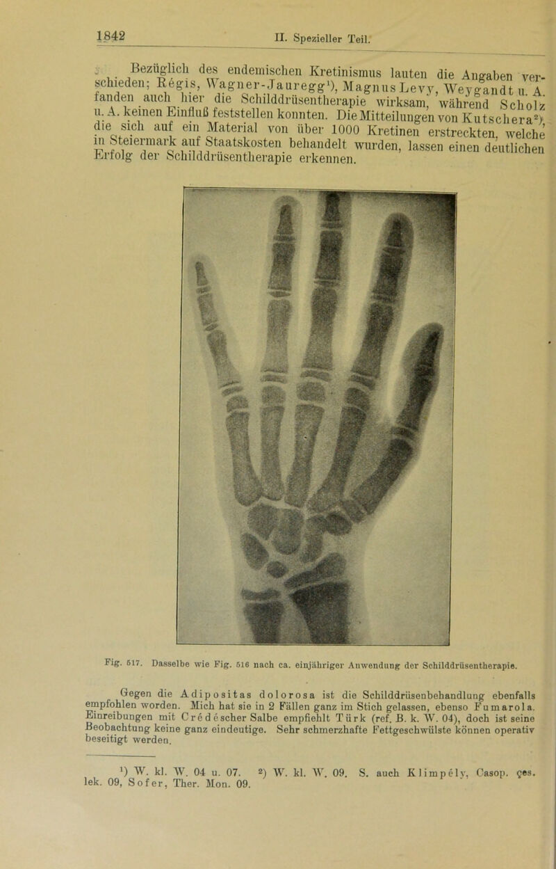 1842 Bezüglich des endemischen Kretinismus lauten die Angaben ver- schieden; Regis, \\ agner- Jauregg1), Magnus Levy, Weygandt u. A. fanden aiicli hier die Schilddrüsentherapie wirksam, während Scholz u. A. keinen Einfluß feststellen konnten. Die Mitteilungen von Kutschera2> dte sich auf ein Material von über 1000 Kretinen erstreckten, welche - Stoermark auf Staatskosten behandelt wurden, lassen einen deutlichen der Schilddrüsentherapie erkennen. Erfolg Fig. 617. Dasselbe wie Fig. 616 nach ca. einjähriger Anwendung der Schilddrüsentherapie. Gegen die Adipositas dolorosa ist die Schilddrüsenbehandlung ebenfalls empfohlen worden. Mich hat sie in 2 Fällen ganz im Stich gelassen, ebenso Fumarola. Einreibungen mit Cre d escher Salbe empfiehlt Türk (ref. B. k. W. 04), doch ist seine Beobachtung keine ganz eindeutige. Sehr schmerzhafte Fettgeschwülste können operativ beseitigt werden. !) AV. kl. AV. 04 u. 07. 2) w. kl. AV. 09. S. auch Klimpe ly, Casop. ges. lek. 09, Sofer, Ther. Mon. 09.