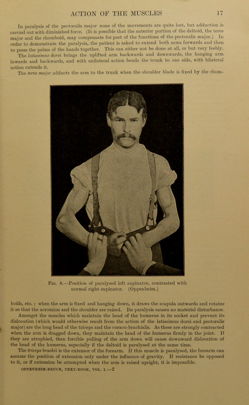 In paralysis of the pectoralis major none of the movements are quite lost, but adduction is carried out with diminished force. (It is possible that the anterior portion of the deltoid, the teies major and the rhomboid, may compensate for part of the functions of the pectoralis major.) In order to demonstrate the paralysis, the patient is asked to extend both arms forwards and then to press the palms of the hands together. Ihis can either not be done at all, 01 but very feebly. The latissimus dorsi brings the uplifted arm backwards and downwards, the hanging arm in wards and backwards, and with unilateral action bends the trunk to one side, with bilateral action extends it. The teres major adducts the arm to the trunk when the shoulder blade is fixed by the rhom- Fig. 8.—Position of paralysed left supinator, contrasted with normal right supinator. (Oppenheim.) boids, etc. ; when the arm is fixed and hanging down, it draws the scapula outwards and rotates it so that the acromion and the shoulder are raised. Its paralysis causes no material disturbance. Amongst the muscles which maintain the head of the humerus in its socket and prevent its dislocation (which would otherwise result from the action of the latissimus dorsi and pectoralis major) are the long head of the triceps and the eoraco-brachialis. As these are strongly contracted when the arm is dragged down, they maintain the head of the humerus firmly in the joint. If they are atrophied, then forcible pulling of the arm down will cause downward dislocation of the head of the humerus, especially if the deltoid is paralysed at the same time. The triceps brachii is the extensor of the forearm. If this muscle is paralysed, the forearm can assume the position of extension only under the influence of gravity. If resistance be opposed to it, or if extension be attempted when the arm is raised upright, it is impossible. OPPENHEIM-BRTXOE, TEXT-BOOK, VOL. I.—2