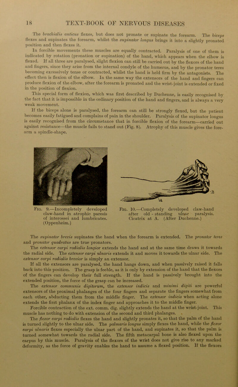 The brachialis anticus flexes, but does not pronate or supinate the forearm. The biceps flexes and supinates the forearm, whilst the supinator longus brings it into a slightly pronated position and then flexes it. In forcible movements these muscles are equally contracted. Paralysis of one of them is indicated by rotation (pronation or supination) of the hand, which appears when the elbow is flexed. If all three are paralysed, slight flexion can still be carried out by the flexors of the hand and fingers, since they arise from the internal condyle of the humerus, and by the pronator teres becoming excessively tense or contracted, whilst the hand is held firm by the antagonists. The effect then is flexion of the elbow. In the same way the extensors of the hand and fingers can produce flexion of the elbow, after the forearm is pronated and the wrist-joint is extended or fixed in the position of flexion. This special form of flexion, which was first described by Duchenne, is easily recognised by the fact that it is impossible hi the ordinary position of the hand and fingers, and is always a very weak movement. If the biceps alone is paralysed, the forearm can still be strongly flexed, but the patient becomes easily fatigued and complains of pain in the shoulder. Paralysis of the supinator longus is easily recognised from the circumstance that in forcible flexion of the forearm—carried out against resistance—the muscle fails to stand out (Fig. 8). Atrophy of this muscle gives the fore- arm a spindle-shape. Fig. 9.—Incompletely developed claw-hand in atrophic paresis of interossei and lumbricates. (Oppenheim.) Fig. 10.—Completely developed claw-hand after old - standing ulnar paralysis. Cicatrix at A. (After Duchenne.) The supinator brevis supinates the hand when the forearm is extended. The pronator teres and pronator quadratus are true pronators. The extensor carpi radialis longior extends the hand and at the same time draws it towards the radial side. The extensor carpi ulnar is extends it and moves it towards the ulnar side. The extensor carpi radialis brevior is simply an extensor. If all the extensors are paralysed, the hand hangs down, and when passively raised it falls back into this position. The grasp is feeble, as it is only by extension of the hand that the flexors of the fingers can develop their full strength. If the hand is passively brought into the extended position, the force of the grasp can be increased. The extensor communis digitorum, the extensor indicis and minimi digiti are powerful extensors of the proximal phalanges of the four fingers and separate the fingers somewhat from each other, abducting them from the middle finger. The extensor indicis when acting alone extends the first phalanx of the index finger and approaches it to the middle finger. Forcible contraction of the ext. comm. dig. slightly extends the hand at the wrist-joint. This muscle has nothing to do with extension of the second and third phalanges. The flexor carpi radialis flexes the hand and slightly pronates it, so that the palm of the hand is turned slightly to the ulnar side. The palmaris longus simply flexes the hand, while the flexor carpi ulnaris flexes especially the ulnar part of the hand, and supinates it, so that the palm is turned somewhat towards the radial side. The fifth metacarpal bone is also flexed upon the carpus by this muscle. Paralysis of the flexors of the wrist does not give rise to any marked deformity, as the force of gravity enables the hand to assume a flexed position. If the flexors