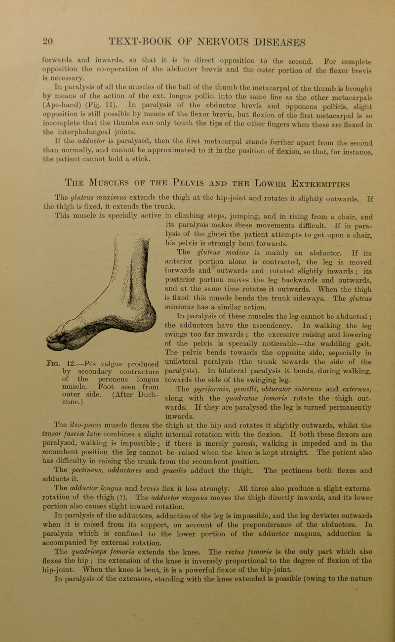 forwards and inwards, so that it is in direct opposition to the second. For complete opposition the co-operation of the abductor brevis and the outer portion of the flexor brevis is necessary. In paralysis of all the muscles of the ball of the thumb the metacarpal of the thumb is brought by means of the action of the ext. longus pollie. into the same line as the other metacarpals (Ape-hand) (Fig. 11). In paralysis of the abductor brevis and opponens pollicis, slight opposition is still possible by means of the flexor brevis, but flexion of the first metacarpal is so incomplete that the thumbs can only touch the tips of the other fingers when these are flexed in the interphalangeal joints. If the adductor is paralysed, then the first metacarpal stands further apart from the second than normally, and cannot be approximated to it in the position of flexion, so that, for instance, the patient cannot hold a stick. The Muscles of the Pelvis and the Lower Extremities The gluteus maximus extends the thigh at the hip-joint and rotates it slightly outwards. If the thigh is fixed, it extends the trunk. This muscle is specially active in climbing steps, jumping, and in rising from a chair, and its paralysis makes these movements difficult. If in para- lysis of the glutei the patient attempts to get upon a chair, his pelvis is strongly bent forwards. The gluteus medius is mainly an abductor. If its anterior portion alone is contracted, the leg is moved forwards and outwards and rotated slightly inwards ; its posterior portion moves the leg backwards and outwards, and at the same time rotates it outwards. When the thigh is fixed this muscle bends the trunk sideways. The gluteus minimus has a similar action. In paralysis of these muscles the leg cannot be abducted ; the adductors have the ascendency. In walking the leg swings too far inwards ; the excessive raising and lowering of the pelvis is specially noticeable—the waddling gait. The pelvis bends towards the opposite side, especially in unilateral paralysis (the trunk towards the side of the paralysis). In bilateral paralysis it bends, during walking, towards the side of the swinging leg. The pyriformis, gemelli, obturator interims and externus, along with the quadratus femoris rotate the thigh out- wards. If they are paralysed the leg is turned permanently inwards. The ileo-psoas muscle flexes the thigh at the hip and rotates it slightly outwards, whilst the tensor fascice latce combines a slight internal rotation with the flexion. If both these flexors are paralysed, walking is impossible ; if there is merely paresis, walking is impeded and in the recumbent position the leg cannot be raised when the knee is kept straight. The patient also has difficulty in raising the trunk from the recumbent position. The pectineus, adductores and gracilis adduct the thigh. The pectineus both flexes and adducts it. Fig. 12.—Pes valgus produced by secondary contracture of the peroneus longus muscle. Foot seen from outer side. (After Duch- enne.) The adductor longus and brevis flex it less strongly. All three also produce a slight externa rotation of the thigh (?). The adductor magnus moves the thigh directly inwards, and its lower portion also causes slight inward rotation. In paralysis of the adductors, adduction of the leg is impossible, and the leg deviates outwards when it is raised from its support, on account of the preponderance of the abductors. In paralysis which is confined to the lower portion of the adductor magnus, adduction is accompanied by external rotation. The quadriceps femoris extends the knee. The rectus femoris is the only part which also flexes the hip ; its extension of the knee is inversely proportional to the degree of flexion of the hip-joint. When the knee is bent, it is a powerful flexor of the hip-joint. In paralysis of the extensors, standing with the knee extended is possible (owing to the nature