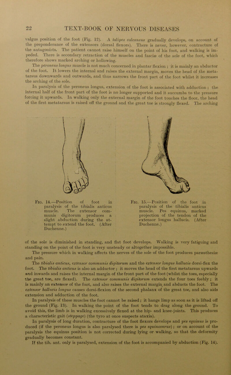 valgus position of the foot (Fig. 12). A talipes calcaneus gradually develops, on account of the preponderance of the extensors (dorsal flexors). There is never, however, contracture of the antagonists. The patient cannot raise himself on the point of his foot, and walking is im- peded. There is secondary retraction of the muscles and fascia; of the sole of the foot, which therefore shows marked arching or hollowing. The peroneus longus muscle is not much concerned in plantar flexion ; it is mainly an abductor of the foot. It lowers the internal and raises the external margin, moves the head of the meta- tarsus downwards and outwards, and thus narrows the front part of the foot whilst it increases the arching of the sole. In paralysis of the peroneus longus, extension of the foot is associated with adduction ; the internal half of the front part of the foot is no longer supported and it succumbs to the pressure forcing it upwards. In walking only the external margin of the foot touches the floor, the head of the first metatarsus is raised off the ground and the great toe is strongly flexed. The arching Fig. 14.—Position of foot in paralysis of the tibialis anticus muscle. The extensor com- munis digitorum produces a slight abduction during the at- tempt to extend the foot. (After Duchenne.) Fig. 15.—Position of the foot in paralysis of the tibialis anticus muscle. Pes equinus, marked projection of the tendon of the extensor longus hallucis. (After Duchenne.) of the sole is diminished in standing, and flat foot develops. Walking is very fatiguing and standing on the point of the foot is very unsteady or altogether impossible. The pressure which in walking affects the nerves of the sole of the foot produces parassthesise and pain. The tibialis anticus, extensor communis digitorum and the extensor longus hallucis dorsi-flex the foot. The tibialis anticus is also an adductor ; it moves the head of the first metatarsus upwards and inwards and raises the internal margin of the front part of the foot (whilst the toes, especially the great toe,, are flexed). The extensor communis digitorum extends the four toes feebly; it is mainly an extensor of the foot, and also raises the external margin and abducts the foot. The extensor hallucis longus causes dorsi-flexion of the second phalanx of the great toe, and also aids extension and adduction of the foot. In paralysis of these muscles the foot cannot be raised; it hangs limp as soon as it is lifted off the ground (Fig. 13). In walking the point of the foot tends to drag along the ground. To avoid this, the limb is in walking excessively flexed at the hip- and knee-joints. This produces a characteristic gait (steppage) (the tyro at once suspects ataxia). In paralysis of long duration, contracture of the foot flexors develops and pes equinus is pro- duced (if the peroneus longus is also paralysed there is pes equinovarus) ; or on account of the paralysis the equinus position is not corrected during lying or walking, so that the deformity gradually becomes constant. If the tib. ant. only is paralysed, extension of the foot is accompanied by abduction (Fig. 14).