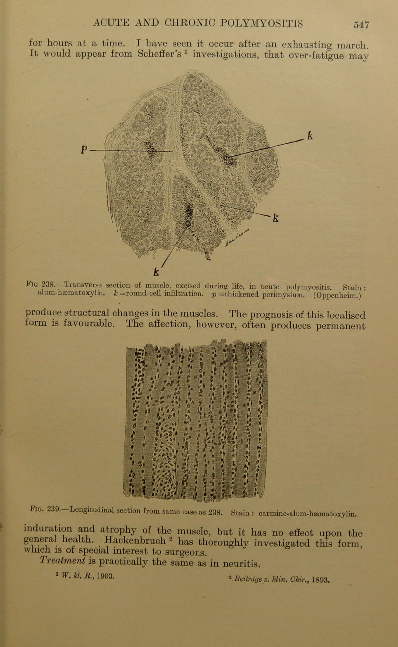 for hours at a tii}ie. I have seen it occur after an exhausting march. It would appear from Scheffer's 1 investigations, that over-fatigue may Fig. 239.—Longitudinal section from same case as 238. Stain : carmine-alum-hsematoxylin. induration and atrophy of the muscle, but it has no effect upon the genera ealth. Hackenbruch 2 has thoroughly investigated this form, which is of special interest to surgeons. TTccitiriETit is practically the same as in neuritis. 1 W. id. R., 1903. Fig 238.—Transverse section of muscle, excised during life, in acute polymyositis. Stain : alum-haematoxylin. k = round-cell infiltration, p ='thickened perimysium. (Oppenheim.) ' produce structural changes in the muscles. The prognosis of this localised form is favourable. The affection, however, often produces permanent Beitrdge z. klin. Chir., 1893.