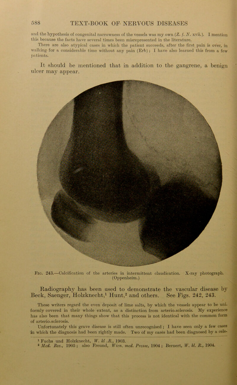 and the hypothesis of congenital narrowness of the vessels was ray own (Z. f. N. xvii.). I mention this because the facts have several times been misrepresented in the literature. There aro also atypical cases in which the patient succeeds, after the first pain is over, in walking for a considerable time without any pain (Erb) ; I have also learned this from a few patients. It should be mentioned that in addition to the gangrene, a benign ulcer may appear. Fig. 243.—Calcification of the arteries in intermittent claudication. X-ray photograph. (Oppenheim.) Radiography has been used to demonstrate the vascular disease by Beck, Saenger, Holzknecht,1 Hunt,2 and others. See Figs. 242, 243. These writers regard the even deposit of lime salts, by which the vessels appear to be uni- formly covered in their whole extent, as a distinction from arterio-sclerosis. My experience has also been that many things show that this process is not identical with the common form of arterio-sclerosis. Unfortunately this grave disease is still often unrecognised ; I have seen only a few cases in which the diagnosis had been rightly made. Two of my cases had been diagnosed by a cele- 1 Fuchs und Holzknecht, W. kl .R., 1903. 2 Med. Rec., .1905 ; also Freund, Wien. med. Pre3.se, 1904; Bernert, IF. kl. R., 1904.