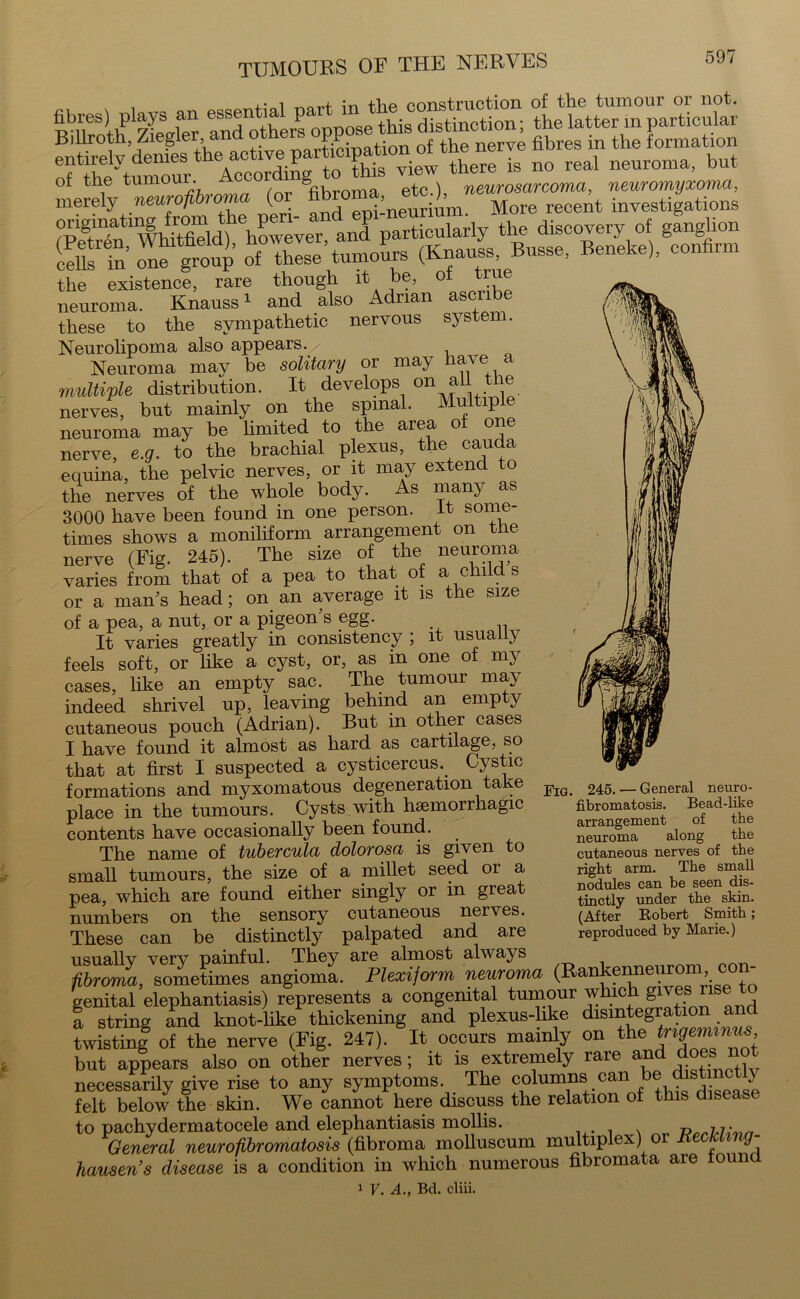 i „„-.i. +1-.P ponstruction of the tumour or not. fibres) pla^ an ^ P se thjg distincti0n; the latter in particular Billroth, Ziegle , ™ ruination of the nerve fibres in the formation CS *his ™w there is 110 real neuroma> but ot the tumour, & . neurosarcoma, neuromyxoma, merely neurofibroma (or fibroma etc.^ ^ recent investigations origmatai^ from e pe^i P oularly the discovery of ganglion (Knauss, Basse, Beneke), confirm the existence, rare though it be, of true neuroma. Knauss1 and also Adrian ascnbe these to the sympathetic nervous system. Neurolipoma also appears. Neuroma may be solitary or may have a multiple distribution. It develops on ah the nerves, but mainly on the spinal. Multip neuroma may be limited to the area of one nerve, e.g. to the brachial plexus, the cauda equina, the pelvic nerves, or it may extend to the nerves of the whole body. As many as 3000 have been found in one person. It some- times shows a moniliform arrangement on tlie nerve (Fig. 245). The size of the neuroma varies from that of a pea to that of a child s or a man’s head; on an average it is the size of a pea, a nut, or a pigeon’s egg. It varies greatly in consistency ; it usually feels soft, or like a cyst, or, as in one of my cases, like an empty sac. The tumour may indeed shrivel up, leaving behind an emp y cutaneous pouch (Adrian). But in other cases I have found it almost as hard as cartilage, so that at first I suspected a cysticercus.. Cystic formations and myxomatous degeneration take place in the tumours. Cysts with haemorrhagic contents have occasionally been found. The name of tubercula dolorosa is given to small tumours, the size of a millet seed or a pea, which are found either singly or in great numbers on the sensory cutaneous nerves. These can be distinctly palpated and are usually very painful. They are almost always fibroma, sometimes angioma. Plexijorm neuroma (Rankemeurom c - genital elephantiasis) represents a congenital tumour which givesi rise a string and knot-like thickening and plexus-like disintegration and twistinf of the nerve (Fig. 247). It occurs mainly on the fnffcmini<6. but appears also on other nerves; it is extremely rare and d°e necessarily give rise to any symptoms. The columns can be Vf* ■ felt below the skin. We cannot here discuss the relation of this disease to pachydermatocele and elephantiasis mollis. p 77- General neurofibromatosis (fibroma molluscum multiplex) or lieckin Jo- hansens disease is a condition in which numerous fibromata are found 1 V. A., Bd. cliii. Fig. 245. — General neuro- fibromatosis. Bead-like arrangement of the neuroma along the cutaneous nerves of the right arm. The small nodules can be seen dis- tinctly under the skin. (After Kobert Smith; reproduced by Marie.)