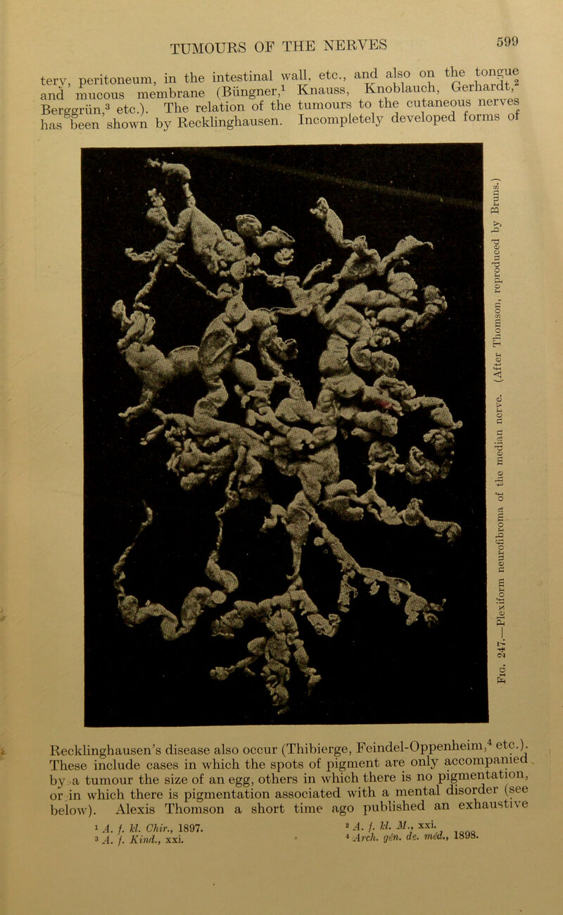 terv peritoneum, in the intestinal wall, etc., and also on the ton?jue and ’ mucous membrane (Biingner,1 Knauss, Knoblauch, Gerhardt Berger tin,3 etc.). The relation of the tumours to the cutaneous nerve has been shown by Recklinghausen. Incompletely developed forms of Recklinghausen’s disease also occur (Thibierge, Feindel-Oppenheim, etc.). These include cases in which the spots of pigment are only accompanie by a tumour the size of an egg, others in which there is no pigmentation, or in which there is pigmentation associated with a mental disorder (see below). Alexis Thomson a short time ago published an exhaustive 1 A. f. Jcl. Ghir., 1897. 3 A. f. Kind., xxi. 2 A. /. U. M., xxi. 4 Arch. gdn. de. mid., 1898.