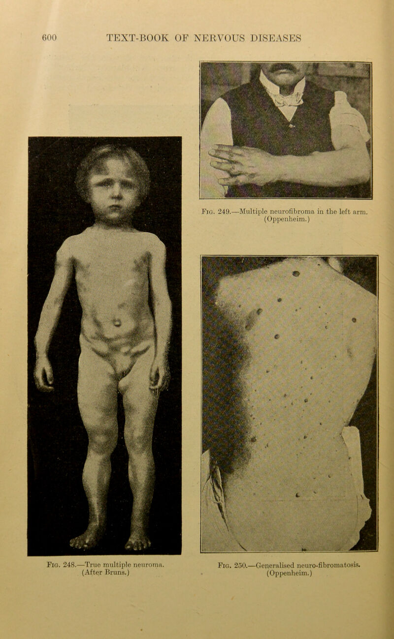 Fig. 248.—True multiple neuroma. (After Bruns.) Fig. 249.—Multiple neurofibroma in the left arm. (Oppenheim.) Fig. 250.—Generalised neuro-fibromatosis. (Oppenheim.)