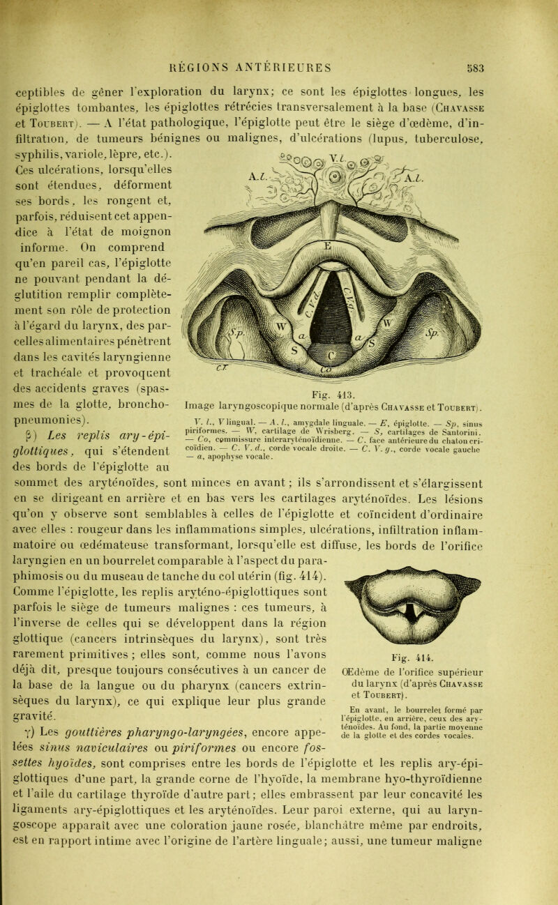 ceptibles de gêner l’exploration du larynx; ce sont les épiglottes longues, les épiglottes tombantes, les épiglottes rétrécies transversalement à la base (Chavasse et Toubert). — A l’état pathologique, l’épiglotte peut être le siège d’œdème, d’in- filtration, de tumeurs bénignes ou malignes, d’ulcérations (lupus, tuberculose, syphilis, variole, lèpre, etc.). Ces ulcérations, lorsqu’elles sont étendues, déforment ses bords , les rongent et, parfois, réduisent cet appen- dice à l’état de moignon informe. On comprend qu’en pareil cas, l’épiglotte ne pouvant pendant la dé- glutition remplir complète- ment son rôle de protection à l’égard du larynx, des par- celles alimentaires pénètrent dans les cavités laryngienne et trachéale et provoquent des accidents graves (spas- mes de la glotte, broncho- pneumonies). P) Les replis ary-épi- glottiques, qui s’étendent des bords de l’épiglotte au sommet des aryténoïdes, sont minces en avant; ils s’arrondissent et s’élargissent en se dirigeant en arrière et en bas vers les cartilages aryténoïdes. Les lésions qu’on y observe sont semblables à celles de l’épiglotte et coïncident d’ordinaire avec elles : rougeur dans les inflammations simples, ulcérations, infiltration inflam- matoire ou œdémateuse transformant, lorsqu’elle est diffuse, les bords de l’orifice laryngien en un bourrelet comparable à l’aspect du para- phimosis ou du museau de tanche du col utérin (fig. 414). Comme l’épiglotte, les replis aryténo-épiglottiques sont parfois le siège de tumeurs malignes : ces tumeurs, à l’inverse de celles qui se développent dans la région glottique (cancers intrinsèques du larynx), sont très rarement primitives ; elles sont, comme nous l’avons déjà dit, presque toujours consécutives à un cancer de la base de la langue ou du pharynx (cancers extrin- sèques du larynx), ce qui explique leur plus grande gravité. y) Les gouttières pharyngo-laryngées, encore appe- lées sinus naviculaires ou piriformes ou encore fos- settes hyoïdes, sont comprises entre les bords de l’épiglotte et les replis ary-épi- glottiques d’une part, la grande corne de l’hyoïde, la membrane hyo-thyroïdienne et l’aile du cartilage thyroïde d’autre part; elles embrassent par leur concavité les ligaments ary-épiglottiques et les aryténoïdes. Leur paroi externe, qui au laryn- goscope apparaît avec une coloration jaune rosée, blanchâtre même par endroits, est en rapport intime avec l’origine de l’artère linguale; aussi, une tumeur maligne Fig. 414. Œdème de l’orifice supérieur du larynx (d’après Chavasse et Toubert). En avant, le bourrelet formé par l'épiglotte, en ari’ière, ceux des ary- ténoïdes. Au fond, la partie moyenne de la glotte et des cordes vocales. Fig. 413. Image larvngoscopique normale (d’après Chavasse et Touberti . F. L, F lingual. — A. L, amygdale linguale. — E, épiglotte. — Sp, sinus piriformes. — W, cartilage de Wrisberg. — S, cartilages de Santorini. — Co, commissure interaryténoïdienne. — C. face antérieure du chaton cri- coïdien. — C. V. d., corde vocale droite. — C. V.g., corde vocale gauche — a, apophyse vocale.