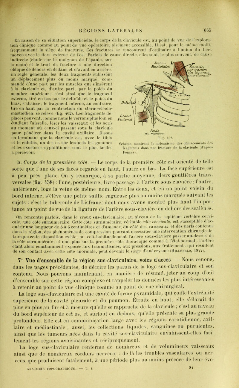En raison de sa situation superficielle, le corps de la clavicule est, au point de vue de l'explora- tion clinique comme au point de vue opératoire, aisément accessible. Il est, pour le même motif, fréquemment le siège de fractures. Ces fractures se rencontrent d'ordinaire à l’union du tiers moven avec le tiers externe de l’os. Parfois de cause directe, elles sont, le plus souvent, de cause indirecte (chute sur le moignon de l'épaule, sur la main) et le trait de fracture a une direction oblique de dehors en dedans et d’avant en arriére- rai règle générale, les deux fragments subissent un déplacement plus ou moins marqué, com- mandé d’une part par les muscles qui s'insèrent à la clavicule et, d'autre part, par le poids du membre supérieur ; c’est ainsi que le fragment externe, tiré en bas par le deltoïde et le poids du bras, s'abaisse ; le fragment interne, au contraire, tiré en haut par la contraction du sterno-cléido- mastoïdien. se relève (fîg. 462). Les fragments dé- placés peuvent, comme nous le verrons plus loin en étudiant l'aisselle, léser les Aaisseaux et les nerfs au moment où ceux-ci passent sous la clavicule pour pénétrer dans la cavité axillaire. Disons en terminant que la clavicule est, avec le tibia et le cubitus, un des os sur lesquels les gommes et les exostoses syphilitiques sont le plus faciles à percevoir. Poids du membre Schéma montrant le mécanisme des déplacements dos fragments dans une fracture de la clavicule (d'après Forgue). b. Corps de la première côte. — Le corps de la première côte est orienté de telle sorte que Tune de ses faces regarde en haut, l’autre en bas. La face supérieure est à peu près plane. On y remarque, à sa partie moyenne, deux gouttières trans- versales (fig. 458) : l’une, postérieure, livre passage à l’artère sous clavière ; l’autre, antérieure, loge la veine de même nom. Entre les deux, et en un point voisin du bord interne, s’élève une petite saillie rugueuse plus ou moins marquée suivant les sujets : c’est le tubercule de Lisfranc, dont nous avons montré plus haut l’impor- tance au point de vue de la ligature de l’artère sous-clavière en dehors desscalènes. On rencontre parfois, dans le creux sus-claviculaire, au niveau de la septième vertèbre cervi- cale, une côte surnuméraire. Cette côte surnuméraire, véritable côte cervicale, est susceptible d ac- quérir une longueur de Ô à 6 centimètres et d’amener, du côté des vaisseaux et des nerfs contenus dans la région, des phénomènes de compression pouvant nécessiter une intervention chirurgicale. Lorsque cette disposition existe, on voit habituellement l’artère sous-clavière passer au-dessus de la côte surnuméraire et non plus sur la première côte thoracique comme à 1 état normal : 1 artère étant alors constamment exposée aux traumatismes, aux pressions, aux frottements qui résultent de son contact avec cette côte anormale, peut devenir le siège d’anévrysme (Hillefeld, 1877). 7° Vue d'ensemble de la région sus-claviculaire, voies d accès. — Nous venons, dans les pages précédentes, de décrire les parois de la loge sus-claviculaire et son contenu. Nous pouvons maintenant, en manière de résumé, jeter un coup d’œil d’ensemble sur cette région complexe et rappeler les données les plus intéressantes à retenir au point de vue clinique comme au point de vue chirurgical. La loge sus-claviculaire est une cavité de forme pyramidale, qui coiffe l’extrémité supérieure de la cavité pleurale et du poumon. Étroite en haut, elle s’élargit de plus en plus au fur et à mesure qu’elle se rapproche de la clavicule ; c’est au niveau du bord supérieur de cet os, et surtout en dedans, qu’elle présente sa plus grande profondeur. Elle est en communication large avec les régions carotidienne, axil- laire et médiastinale ; aussi, les collections liquides, sanguines ou purulentes, ainsi que les tumeurs nées dans la cavité sus-claviculaire envahissent-elles faci- lement les régions avoisinantes et réciproquement. La loge sus-claviculaire renferme de nombreux et de volumineux vaisseaux ainsi que de nombreux cordons nerveux : de là les troubles vasculaires ou ner- veux que produisent fatalement, à une période plus ou moins précoce de leur évo- 84 ANATOMIE TOPOGRAPHIQUE. — T.