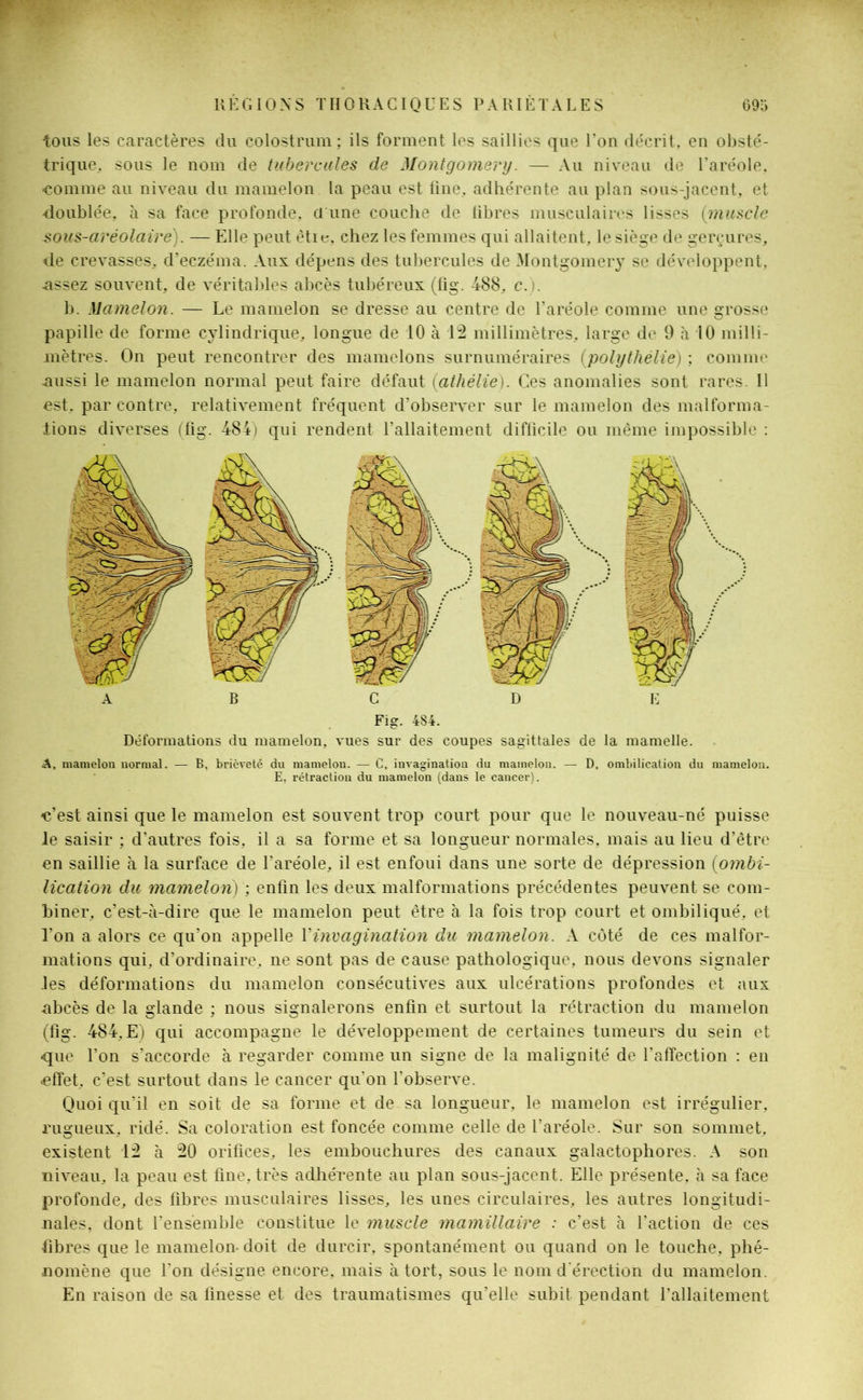 tous les caractères du colostrum ; ils forment les saillies que Ton décrit, en obsté- trique, sous le nom de tubercules de Montgomery. — Au niveau de l’aréole, -comme au niveau du mamelon la peau est fine, adhérente au plan sous-jacent, et -doublée, à sa face profonde, a une couche de fibres musculaires lisses (muscle sous-aréolaire). — Elle peut êtie, chez les femmes qui allaitent, le siège de gerçures, de crevasses, d’eczéma. Aux dépens des tubercules de Montgomery se développent, •assez souvent, de véritables abcès tubéreux (fig. 488, c.i. b. Mamelon. — Le mamelon se dresse au centre de l’aréole comme une grosse papille de forme cylindrique, longue de 10 à 12 millimètres, large de 9 à 10 milli- mètres. On peut rencontrer des mamelons surnuméraires (polythélie) ; comme .aussi le mamelon normal peut faire défaut (athélie). Ces anomalies sont rares. Il est, par contre, relativement fréquent d’observer sur le mamelon des malforma- lions diverses (fig. 484) qui rendent l’allaitement difficile ou même impossible : Fig. 484. Déformations du mamelon, vues sur des coupes sagittales de la mamelle. A, mamelon normal. — B, brièveté du mamelon. — C, invagination du mamelon. — D, ombilication du mamelon. E, rétraction du mamelon (dans le cancer). -c’est ainsi que le mamelon est souvent trop court pour que le nouveau-né puisse Je saisir ; d’autres fois, il a sa forme et sa longueur normales, mais au lieu d’être en saillie à la surface de l’aréole, il est enfoui dans une sorte de dépression (ombi- lication du mamelon) ; enfin les deux malformations précédentes peuvent se com- biner, c’est-à-dire que le mamelon peut être à la fois trop court et ombiliqué, et l’on a alors ce qu’on appelle Y invagination du mamelon. A côté de ces malfor- mations qui, d’ordinaire, ne sont pas de cause pathologique, nous devons signaler les déformations du mamelon consécutives aux ulcérations profondes et aux abcès de la glande ; nous signalerons enfin et surtout la rétraction du mamelon (fig. 484, E) qui accompagne le développement de certaines tumeurs du sein et que l’on s’accorde à regarder comme un signe de la malignité de l’affection : en «effet, c’est surtout dans le cancer qu’on l’observe. Quoi qu’il en soit de sa forme et de sa longueur, le mamelon est irrégulier, rugueux, ridé. Sa coloration est foncée comme celle de l’aréole. Sur son sommet, existent 1:2 à 20 orifices, les embouchures des canaux galactophores. A son niveau, la peau est fine, très adhérente au plan sous-jacent. Elle présente, à sa face profonde, des fibres musculaires lisses, les unes circulaires, les autres longitudi- nales, dont l’ensemble constitue le muscle mamülaire : c’est à l’action de ces fibres que le mamelon- doit de durcir, spontanément ou quand on le touche, phé- nomène que l'on désigne encore, mais à tort, sous le nom d'érection du mamelon. En raison de sa finesse et des traumatismes qu’elle subit pendant l’allaitement