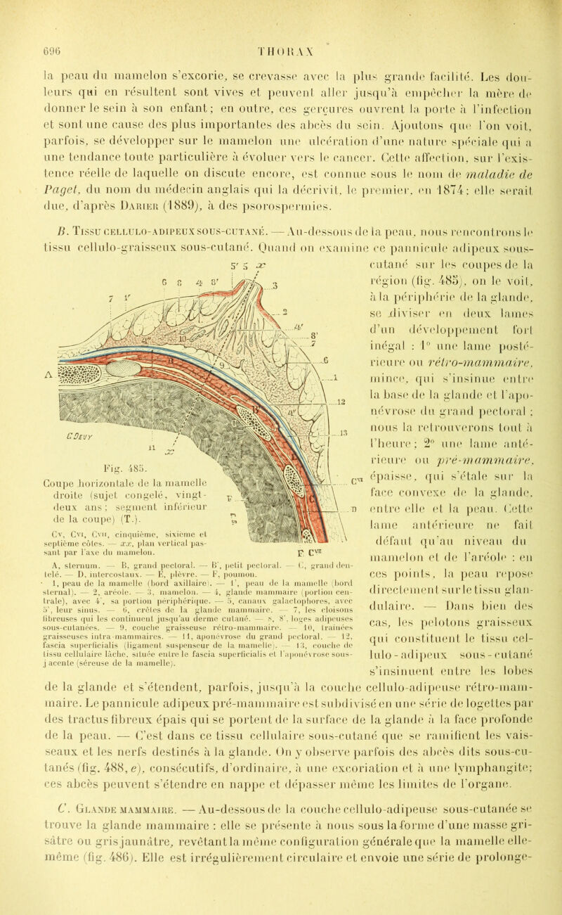 la peau du mamelon s’excorie, se crevasse avec la plus grande facilité. Les dou- leurs qui en résultent sont vives et peuvent aller jusqu’à empêcher la mère de donner le sein à son enfant; en outre, ces gerçures ouvrent la porte à l’infection et sont une cause des plus importantes des abcès du soin. Ajoutons que l'on voit, parfois, se développer sur le mamelon une ulcération d’une nature spéciale qui a une tendance toute particulière à évoluer vers le cancer. Cette affection, sur l’exis- tence réelle de laquelle on discute encore, est connue sous le nom de maladie de Paget, du nom du médecin anglais qui la décrivit, le premier, en 1874 : elle serait due, d’après Darier (1889), à des psorospermies. B. Tissu cellulo-adipeux sous-cutané. — Au-dessous de la peau, nous rencontrons le tissu cellulo-graisseux sous-cutané. Quand on examine ce pannicule adipeux sous- G.Oevy il Fig. 485. Coupe horizontale de la mamelle droite (sujet congelé, vingt- deux ans ; segment inférieur de la coupe) (T.). Cv, Cvi, Cvii, cinquième, sixième et septième côtes. — xx, plan vertical pas- sant par l’axe du mamelon. 13 F. C™ A, sternum. — B, grand pectoral. — B‘, petit pecloral. — C, grand den- telé. — D, intercostaux. — E, plèvre. — F, poumon. 1, peau de la mamelle (bord axillaire). — 1 peau de la mamelle (bord sternal). — 2, aréole. — 3, mamelon. — 4, glande mammaire (porlion cen- trale), avec 4‘, sa portion périphérique. — 5, canaux galactophores, avec d’, leur sinus. — G, crêtes de la glande mammaire. — 7, les cloisons fibreuses qui les continuent jusqu’au derme cutané. — ?>, 8'. loges adipeuses sous-cutanées. — 9, couche graisseuse rétro-mammaire. — 10, tramées graisseuses intra-mammaires. — 11, aponévrose du grand pectoral. — 12, fascia superficialis (ligament suspenseur de la mamelle). — 13, couche de tissu cellulaire lâche, située entre le fascia superficialis et l'aponévrose sous- j acente (séreuse de la mamelle). cutané sur les coupes de la région (fig. 485), on le voit, à la périphérie de la glande, se jdiviser en deux lames d’un développement fort inégal : 1° une lame posté- rieure ou rétro-mammaire, mince, qui s’insinue entre la base de la glande et l’apo- névrose du grand pectoral : nous la retrouverons tout à l’heure ; 2° une lame anté- rieure ou pré-mammaire, épaisse, qui s’étale sur la face convexe de la glande, entre elle et la peau. Cette lame antérieure ne fait défaut qu’au niveau du mamelon et de l’aréole : en ces points, la peau repose directement sur le tissu glan- dulaire. — Dans bien des cas, les pelotons graisseux qui constituent le tissu cel- lulo - adipeux sous - cutané s’insinuent entre les lobes de la glande et s’étendent, parfois, jusqu’à la couche cellulo-adipeuse rétro-mam- maire. Le pannicule adipeux pré-mammaire est subdivisé en une série de logettes par des tractus fibreux épais qui se portent de la surface de la glande à la face profonde de la peau. — C’est dans ce tissu cellulaire sous-cutané que se ramifient les vais- seaux et les nerfs destinés à la glande. On y observe parfois des abcès dits sous-cu- tanés (fig. 488, e), consécutifs, d’ordinaire, à une excoriation et à une lymphangite; ces abcès peuvent s’étendre en nappe et dépasser même les limites de l’organe. C. Glande mammaire. —Au-dessous de la couche cellulo-adipeuse sous-cutanée se trouve la glande mammaire : elle se présente à nous sous la forme d’une masse gri- sâtre ou gris jaunâtre, revêtant la même configuration générale que la mamelle elle- même (fig. 486j. Elle est irrégulièrement circulaire et envoie une série de prolonge-