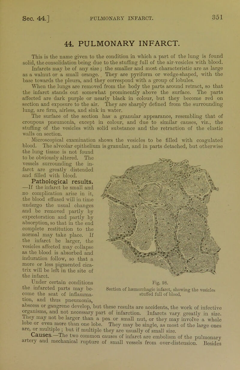 44. PULMONARY INFARCT. This is the name given to the condition in which a part of the lung is found solid, the consolidation being due to the stuffing full of the air-vesicles with blood. Infarcts may be of any size; the smaller and most characteristic are as large as a walnut or a small orange. They are pyriform or wedge-shaped, with the base towards the pleura, and they correspond with a group of lobules. When the lungs are removed from the body the parts around retract, so that the infarct stands out somewhat prominently above the surface. The parts affected are dark purple or nearly black in colour, but they become red on section and exposure to the air. They are sharply defined from the surrounding lung, are firm, airless, and sink in water. The surface of the section has a granular appearance, resembling that of croupous pneumonia, except in colour, and due to similar causes, viz., the stuffing of the vesicles with solid substance and the retraction of the elastic walls on section. Microscopical examination shows the vesicles to be filled with coagulated blood. The alveolar epithelium is granular, and in parts detached, but otherwise the lung tissue is not found to be obviously altered. The vessels surrounding the in- farct are greatly distended and filled with blood. Pathological results. —If the infarct be small and no complication arise in it, the blood effused will in time undergo the usual changes and be removed partly by expectoration and partly by absorption, so that in the end complete restitution to the normal may take place. If the infarct be larger, the vesicles affected may collapse as the blood is absorbed and induration follow, so that a more or less pigmented cica- trix will be left in the site of the infarct. Under certain conditions the infarcted parts may be- come the seat of inflamma- tion, and thus pneumonia, abscess or gangrene develop, but these results are accidents, the work of infective organisms, and not necessary part of infarction. Infarcts vary greatly in size. ley may not be larger than a pea or small nut, or they may involve a whole obe or even more than one lobe. They may be single, as most of the large ones are, or multiple ; but if multiple they are usually of small size. Causes. The two common causes of infarct are embolism of the pulmonary arteiy and mechanical rupture of small vessels from over-distension. Besides Fig. 98. Section of haemorrhagic infarct, showing the vesicles stuffed full of blood.