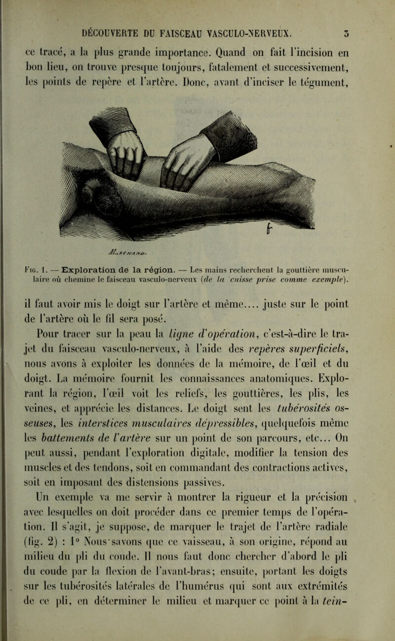 ce tracé, a la plus grande importance. Quand on fait l’incision en bon lieu, on trouve presque toujours, fatalement et successivement, les points de repère et l’artère. Donc, avant d’inciser le tégument, M/t Ar£>. Fig. 1. — Exploration de la région. — Les mains recherchent la gouttière muscu- laire où chemine le faisceau vasculo-nervcux (de la cuisse prise comme exemple). il faut avoir mis le doigt sur l’artère et même.... juste sur le point de l’artère où le fil sera posé. Pour tracer sur la peau la ligne d'opération, c’est-à-dire le tra- jet du faisceau vasculo-nervcux, à l’aide des repères superficiels, nous avons à exploiter les données de la mémoire, de l’œil et du doigt. La mémoire fournit les connaissances anatomiques. Explo- rant la région, l’œil voit les reliefs, les gouttières, les plis, les veines, et apprécie les distances. Le doigt sent les tubérosités os- seuses, les interstices musculaires dépressibles, quelquefois même les battements de l'artère sur un point de son parcours, etc... On peut aussi, pendant l’exploration digitale, modifier la tension des muscles et des tendons, soit en commandant des contractions actives, soit en imposant des distensions passives. Un exemple va me servir à montrer la rigueur et la précision avec lesquelles on doit procéder dans ce premier temps de l’opéra- tion. Il s’agit, je suppose, de marquer le trajet de l’artère radiale (fig. 2) : 1° Nous'savons que ce vaisseau, à son origine, répond au milieu du pli du coude. Il nous faut donc chercher d’abord le pli du coude par la flexion de l’avant-bras; ensuite, portant les doigts sur les tubérosités latérales de l’humérus qui sont aux extrémités de ce pli, en déterminer le milieu et marquer ce point à la tein-