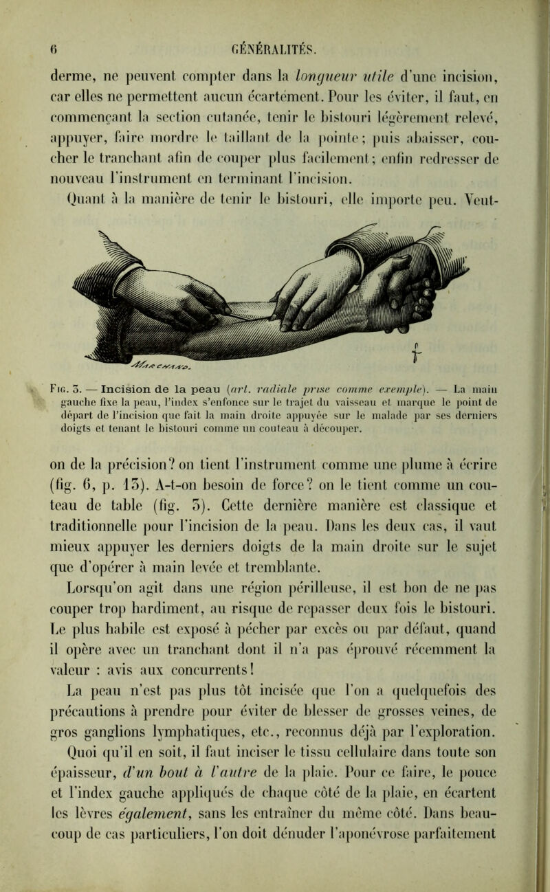 derme, ne peuvent compter dans la longueur utile d’une incision, car elles ne permettent aucun écartement. Pour les éviter, il faut, en commençant la section cutanée, tenir le bistouri légèrement relevé, appuyer, faire mordre le taillant de la pointe; puis abaisser, cou- cher le tranchant afin de couper plus facilement; enfin redresser de nouveau l’instrument en terminant l’incision. Quant à la manière de tenir le bistouri, elle importe peu. Veut- Fig. 3. — Incision de la peau (art. radiale prise comme exemple). — La main gauche fixe la peau, l’index s’enfonce sur le trajet du vaisseau et marque le point de départ de l’incision que fait la main droite appuyée sur le malade par ses derniers doigts et tenant le bistouri comme un couteau à découper. on de la précision? on tient l’instrument comme une plume à écrire (fig. 6, p. 13). A-t-on besoin de force? on le tient comme un cou- teau de table (fig. 3). Cette dernière manière est classique et traditionnelle pour l’incision de la peau. Dans les deux cas, il vaut mieux appuyer les derniers doigts de la main droite sur le sujet que d’opérer à main levée et tremblante. Lorsqu’on agit dans une région périlleuse, il est bon de ne pas couper trop hardiment, au risque de repasser deux fois le bistouri. Le plus habile est exposé à pécher par excès ou par défaut, quand il opère avec un tranchant dont il n’a pas éprouvé récemment la valeur : avis aux concurrents! La peau n’est pas plus tôt incisée que l’on a quelquefois des précautions à prendre pour éviter de blesser de grosses veines, de gros ganglions lymphatiques, etc., reconnus déjà par l’exploration. Quoi qu’il en soit, il faut inciser le tissu cellulaire dans toute son épaisseur, d'un bout à Vautre de la plaie. Pour ce faire, le pouce et l’index gauche appliqués de chaque côté de la plaie, en écartent les lèvres également, sans les entraîner du môme côté. Dans beau- coup de cas particuliers, l’on doit dénuder l’aponévrose parfaitement