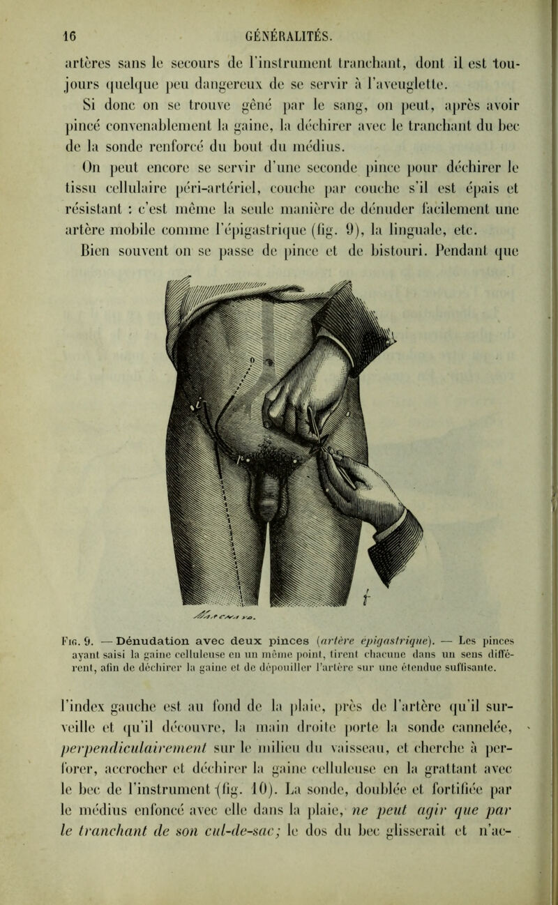 artères sans le secours de l’instrument tranchant, dont il est tou- jours quelque peu dangereux de se servir à l’aveuglette. Si donc on se trouve gêné par le sang, on peut, après avoir pincé convenablement la gaine, la déchirer avec le tranchant du bec de la sonde renforcé du bout du médius. On peut encore se servir d’une seconde pince pour déchirer le tissu cellulaire péri-artériel, couche par couche s’il est épais et résistant : c’est même la seule manière de dénuder facilement une artère mobile comme l’épigastrique (fig. 9), la linguale, etc. Bien souvent on se passe de pince et de bistouri. Pendant que Fig. 9. — Dénudation avec deux pinces (artère épigastrique). — Les pinces ayant saisi la gaine celluleuse en un même point, tirent chacune dans un sens diffé- rent, afin de déchirer la gaine et de dépouiller l’artère sur une étendue suffisante. l’index gauche est au fond de la plaie, près de l’artère qu’il sur- veille et qu’il découvre, la main droite porte la sonde cannelée, perpendiculairement sur le milieu du vaisseau, et cherche à per- forer, accrocher et déchirer la gaine celluleuse en la grattant avec le bec de l’instrument-(fig. 10). La sonde, doublée et fortifiée par le médius enfoncé avec elle dans la plaie, ne peut agir que par le tranchant de son cul-de-sac: le dos du bec glisserait et n’ac-