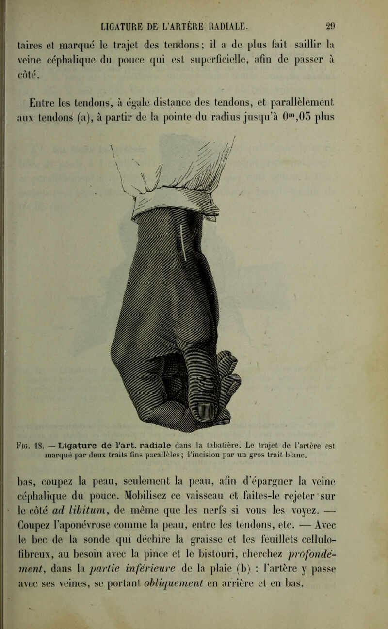 taires et marqué le trajet des tendons ; il a de plus fait saillir la veine céphalique du pouce qui est superficielle, afin de passer à côté. Entre les tendons, à égale distance des tendons, et parallèlement aux tendons (a), à partir de la pointe du radius jusqu’à 0m,0o plus Fig. 18. — Ligature de l’art, radiale dans la tabatière. Le trajet de l’artère est marqué par deux traits fins parallèles ; l’incision par un gros trait blanc. bas, coupez la peau, seulement la peau, afin d’épargner la veine céphalique du pouce. Mobilisez ce vaisseau et faites-le rejeter sur le côté ad libitum, de môme que les nerfs si vous les voyez. — Coupez l’aponévrose comme la peau, entre les tendons, etc. — Avec le bec de la sonde qui déchire la graisse et les feuillets cellulo- fibreux, au besoin avec la pince et le bistouri, cherchez profondé- ment, dans la partie inférieure de la plaie (b) : l’artère y passe avec ses veines, se portant obliquement en arrière et en bas.