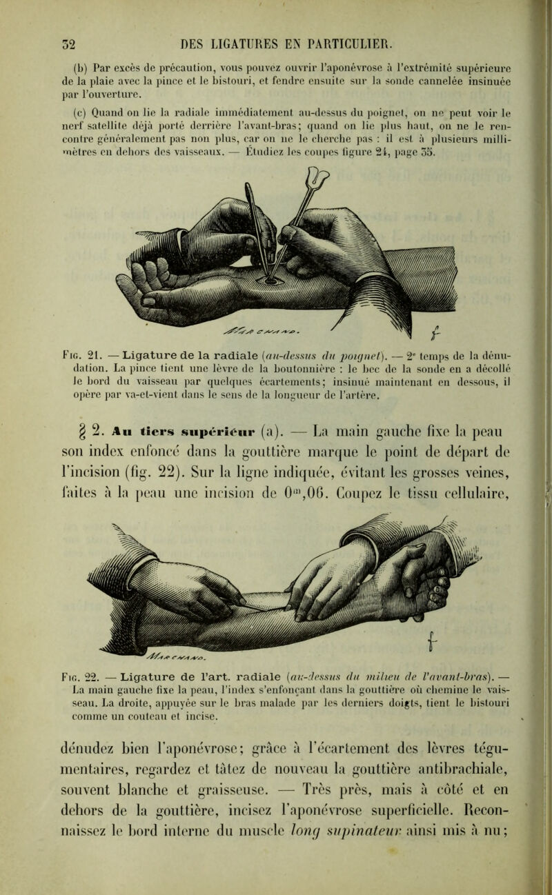 (b) Par excès de précaution, vous pouvez ouvrir l’aponévrose à l’extrémité supérieure de la plaie avec la pince et le bistouri, et fendre ensuite sur la sonde cannelée insinuée par l’ouverture. (c) Quand on lie la radiale immédiatement au-dessus du poignet, on ne peut voir le nerf satellite déjà porté derrière l’avant-bras; quand on lie plus haut, on ne le ren- contre généralement pas non plus, car on ue le cherche pas : il est à plusieurs milli- mètres en dehors des vaisseaux. — Étudiez les coupes figure 2i, page 35. Fig. 21. — Ligature de la radiale (au-dessus du poignet). — 2‘ temps de la dénu- dation. La pince tient une lèvre de la boutonnière : le hcc de la sonde en a décollé Je bord du vaisseau par quelques écartements; insinué maintenant en dessous, il opère par va-et-vient dans le sens de la longueur de l’artère. § 2. Au tiers supérieur (a). — La main gauche fixe la peau son index enfoncé dans la gouttière marque le point de départ de l’incision (fig. 22). Sur la ligne indiquée, évitant les grosses veines, faites à la peau une incision de 0m,06. Coupez le tissu cellulaire, Fig. 22. —Ligature de l’art, radiale (au-dessus du milieu de Vavant-bras).— La main gauche fixe la peau, l’index s’enfonçant dans la gouttière où chemine le vais- seau. La droite, appuyée sur le bras malade par les derniers doigts, tient le bistouri comme un couteau et incise. dénudez bien l’aponévrose; grâce à l’écartement des lèvres tégu- mentaires, regardez et tâtez de nouveau la gouttière antibrachiale, souvent blanche et graisseuse. — Très près, mais à côté et en dehors de la gouttière, incisez l’aponévrose superficielle. Recon- naissez le bord interne du muscle long supinateur, ainsi mis â nu ;