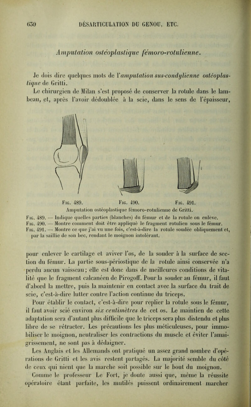 Amputation ostéoplastique fémoro-rotulienne. Je dois dire quelques mots de Y amputation sus-condylienne ostéoplas- tique de Gritti. Le chirurgien de Milan s’est proposé de conserver la rotule dans le lam- beau, et, après l’avoir dédoublée à la scie, dans le sens de l’épaisseur, Fig. 489. — Indique quelles parties (blanches) du fémur et de la rotule on enlève. Fig. 490. — Montre comment doit être appliqué le fragment rotulien sous le fémur. Fig. 491. — Montre ce que j’ai vu une fois, c’est-à-dire la rotule soudée obliquement et, par la saillie de son bec, rendant le moignon intolérant. pour enlever le cartilage et aviver l’os, de la souder à la surface de sec- tion du fémur. La partie sous-périostique de la rotule ainsi conservée n’a perdu aucun vaisseau ; elle est donc dans de meilleures conditions de vita- lité que le fragment calcanéen de Pirogoff. Pour la souder au fémur, il faut d’abord la mettre, puis la maintenir en contact avec la surface du trait de scie, c’est-à-dire lutter contre l’action continue du triceps. Pour établir le contact, c’est-à-dire pour replier la rotule sous le fémur, il faut avoir scié environ six centimètres de cet os. Le maintien de cette adaptation sera d’autant plus difficile que le triceps sera plus distendu et plus libre de se rétracter. Les précautions les plus méticuleuses, pour immo- biliser le moignon, neutraliser les contractions du muscle et éviter l’amai- grissement, ne sont pas à dédaigner. Les Anglais et les Allemands ont pratiqué un assez grand nombre d’opé- rations de Gritti et les avis restent partagés. La majorité semble du côté de ceux qui nient que la marche soit possible sur le bout du moignon. Comme le professeur Le Fort, je doute aussi que, même la réussite opératoire étant parfaite, les mutilés puissent ordinairement marcher