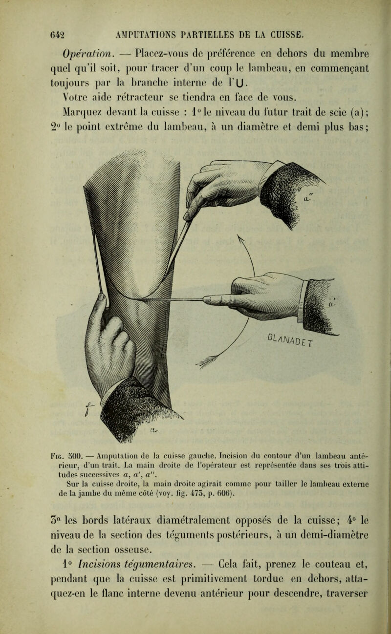 Opération. — Placez-vous de préférence en dehors du membre quel qu’il soit, pour tracer d’un coup le lambeau, en commençant toujours par la branche interne de l’U- Votre aide rétracteur se tiendra en face de vous. Marquez devant la cuisse : 10 le niveau du futur trait de scie (a) ; 2° le point extrême du lambeau, à un diamètre et demi plus bas; Fig. 500. — Amputation de la cuisse gauche. Incision du contour d’un lambeau anté- rieur, d’un trait. La main droite de l’opérateur est représentée dans ses trois atti- tudes successives a, a', a. Sur la cuisse droite, la main droite agirait comme pour tailler le lambeau externe de la jambe du même côté (voy. fig. 473, p. 606). 3° les bords latéraux diamétralement opposés de la cuisse ; 4° le niveau de la section des téguments postérieurs, à un demi-diamètre de la section osseuse. 1° Incisions tégumentaires. — Cela fait, prenez le couteau et, pendant que la cuisse est primitivement tordue en dehors, atta- quez-en le flanc interne devenu antérieur pour descendre, traverser
