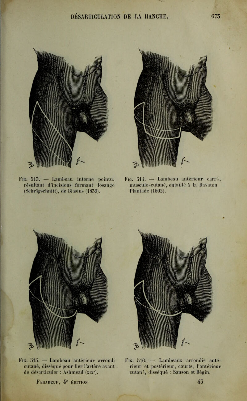 Fig. 515. — Lambeau interne pointu, résultant d’incisions formant losange (Schragschnitt), de Dlasius (1839). Fig. 514. — Lambeau antérieur carré, musculo-cutané, entaillé à la Ravaton Plantade (1803). Fig. 515. — Lambeau antérieur arrondi cutané, disséqué pour lier l'artère avant de désarticuler : Ashmcad (xix°). Fahabeuf, 4e édition Fig. 516. — Lambeaux arrondis anté- rieur et postérieur, courts, l’antérieur cutan j, disséqué : Sanson et Bégin. 43