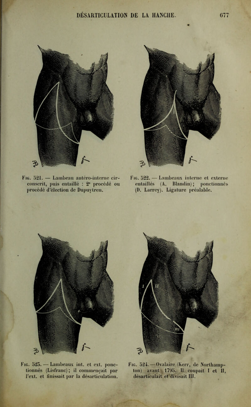 Fig. 521. — Lambeau aatéro-interne cir- conscrit, puis entaillé : 2* procédé ou procédé d’élection de Dupuylren. Fig. 522. — Lambeaux interne et externe entaillés (A. Blandin) ; ponctionnés (D. Larrey). Ligature préalable. Fig. 523. — Lambeaux int. et ext. ponc- tionnés (Lisfranc) ; il commençait par l’ext. et finissait par la désarticulation. Fig. 521. — Ovalaire (Kcrr, de Northamp- ton) avant1795. Il coupait I et II. désarticulait et divisait III.