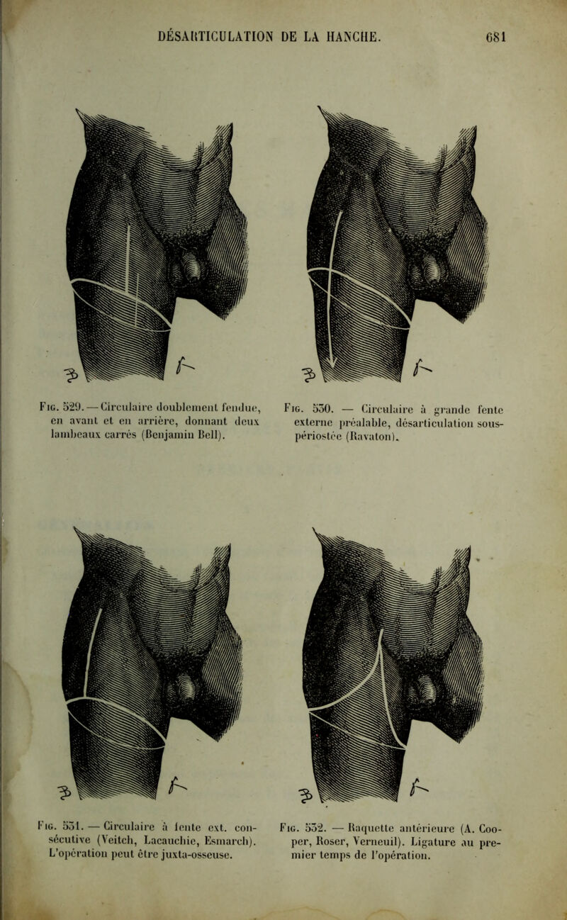 Fig. 529. — Circulaire doublement fendue, en avant et en arrière, donnant deux lambeaux carrés (Benjamin Bell). Fig. 530. — Circulaire à grande fente externe préalable, désarticulation sous- périostée (RavatonL Fig. 531. — Circulaire à lente cxt. con- sécutive (Veitch, Lacauchic, Esmarch). L’opération peut être juxta-osseuse. Fig. 552. — Raquette antérieure (A. Coo- per, Roser, Verneuil). Ligature au pre- mier temps de l’opération.