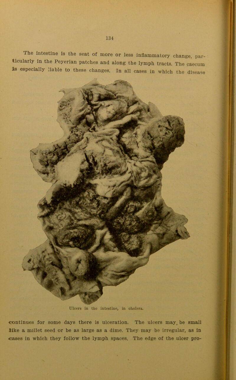 The intestine is the seat of more or less inflammatory change, par- ticularly in the Peyerian patches and along the lymph tracts. The caecum 3s especially liable to these changes. In all cases in which the disease continues for some days there is ulceration. The ulcers may, be small like a millet seed or be as large as a dime. They may be irregular, as in cases in which they follow the lymph spaces. The edge of the ulcer pro-