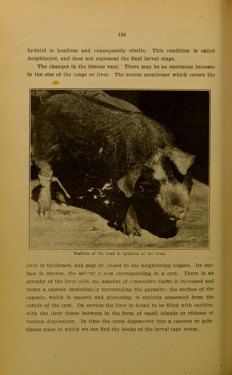 hydatid is headless and consequently sterile. This condition is called Acephlocyst, and does not represent the final larval stage. The changes in the tissues vary. There may be an enormous increase in the size of the lungs or liver. The serous membrane which covers the Position of the head in hydatids of the brain. liver is thickened, and may be joined to the neighboring organs. Its sur- face is uneven, the salient p aces corresponding to a cyst. There is an atrophy of the liver cells, tm, amount of connective tissfle is increased and forms a capsule immediately surrounding the parasite; the surface of the capsule, which is smooth and glistening, is entirely separated from the cuticle of the cyst. On section the liver is found to be filled with cavities, with the liver tissue between in the form of small islands or ribbons or various dimensions. In time the cysts degenerate into a caseous or gela- tinous mass in which we can find the hooks of the larval tape worm.