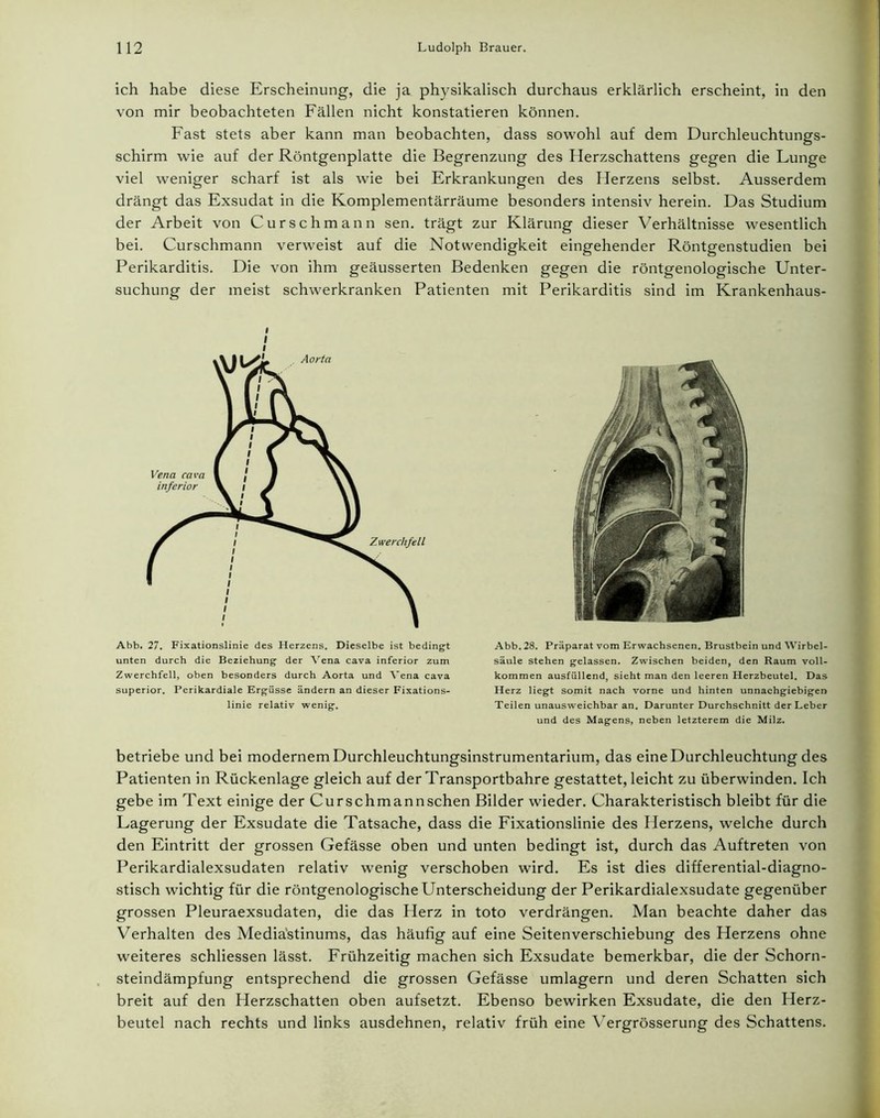 ich habe diese Erscheinung, die ja physikalisch durchaus erklärlich erscheint, in den von mir beobachteten Fällen nicht konstatieren können. Fast stets aber kann man beobachten, dass sowohl auf dem Durchleuchtungs- schirm wie auf der Röntgenplatte die Begrenzung des Herzschattens gegen die Lunge viel weniger scharf ist als wie bei Erkrankungen des Herzens selbst. Ausserdem drängt das Exsudat in die Komplementärräume besonders intensiv herein. Das Studium der Arbeit von Curschmann sen. trägt zur Klärung dieser Verhältnisse wesentlich bei. Curschmann verweist auf die Notwendigkeit eingehender Röntgenstudien bei Perikarditis. Die von ihm geäusserten Bedenken gegen die röntgenologische Unter- suchung der meist schwerkranken Patienten mit Perikarditis sind im Krankenhaus- Abb. 27. Fixationslinie des Herzens. Dieselbe ist bedingt unten durch die Beziehung der Vena cava inferior zum Zwerchfell, oben besonders durch Aorta und Vena cava superior. Perikardiale Ergüsse ändern an dieser Fixations- linie relativ wenig. Abb. 28. Präparat vom Erwachsenen. Brustbein und Wirbel- säule stehen gelassen. Zwischen beiden, den Raum voll- kommen ausfüllend, sieht man den leeren Herzbeutel. Das Herz liegt somit nach vorne und hinten unnachgiebigen Teilen unausweichbar an. Darunter Durchschnitt der Leber und des Magens, neben letzterem die Milz. betriebe und bei modernem Durchleuchtungsinstrumentarium, das eine Durchleuchtung des Patienten in Rückenlage gleich auf der Transportbahre gestattet, leicht zu überwinden. Ich gebe im Text einige der Curschmannschen Bilder wieder. Charakteristisch bleibt für die Lagerung der Exsudate die Tatsache, dass die Fixationslinie des Herzens, welche durch den Eintritt der grossen Gefässe oben und unten bedingt ist, durch das Auftreten von Perikardialexsudaten relativ wenig verschoben wird. Es ist dies differential-diagno- stisch wichtig für die röntgenologische Unterscheidung der Perikardialexsudate gegenüber grossen Pleuraexsudaten, die das Herz in toto verdrängen. Man beachte daher das Verhalten des Mediastinums, das häufig auf eine Seitenverschiebung des Herzens ohne weiteres schliessen lässt. Frühzeitig machen sich Exsudate bemerkbar, die der Schorn- steindämpfung entsprechend die grossen Gefässe umlagern und deren Schatten sich breit auf den Herzschatten oben aufsetzt. Ebenso bewirken Exsudate, die den Herz- beutel nach rechts und links ausdehnen, relativ früh eine Vergrösserung des Schattens.